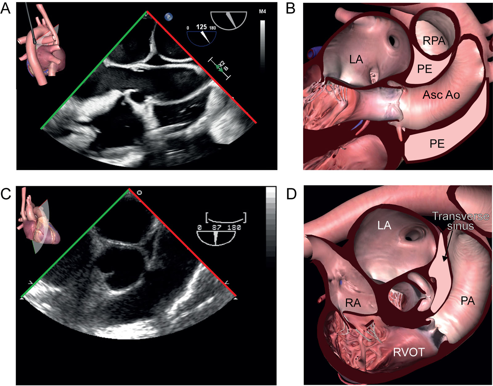 Transverse pericardial sinus. (A, B) The transverse pericardial sinus in this ME ascending Ao LAX view at 120° appears as a small triangular echo-free space between the ascending Ao and RPA. (C, D) This ME RV inflow/outflow view shows the transverse sinus just beside the Ao.<em> Abbreviations</em>: Ao, aorta; Asc, ascending; LA, left atrium; LAX, long-axis; ME, mid-esophageal; PA, pulmonary artery; PE, pericardial effusions; RA, right atrium; RPA, right pulmonary artery; RV, right ventricle; RVOT, right ventricular outflow tract.<i class='fa fa-video-camera' aria-hidden='true'></i>
