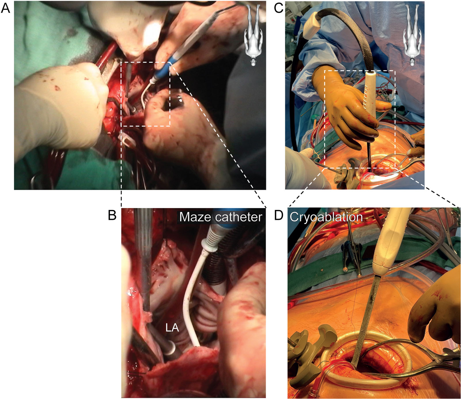 Maze procedure (A,B) During the closure of an atrial septal defect in a 48-year-old man, the surgeon performs a Maze procedure for chronic atrial fibrillation. At that point, the echocardiographer pulls back the TEE probe to above the LA to avoid esophageal damage. (C,D) Cryoablation is applied around the pulmonary veins in order to prevent atrial fibrillation. Using this technique, there is no need of removing the TEE probe. Abbreviation: LA, left atrium; TEE, transesophageal echocardiography.