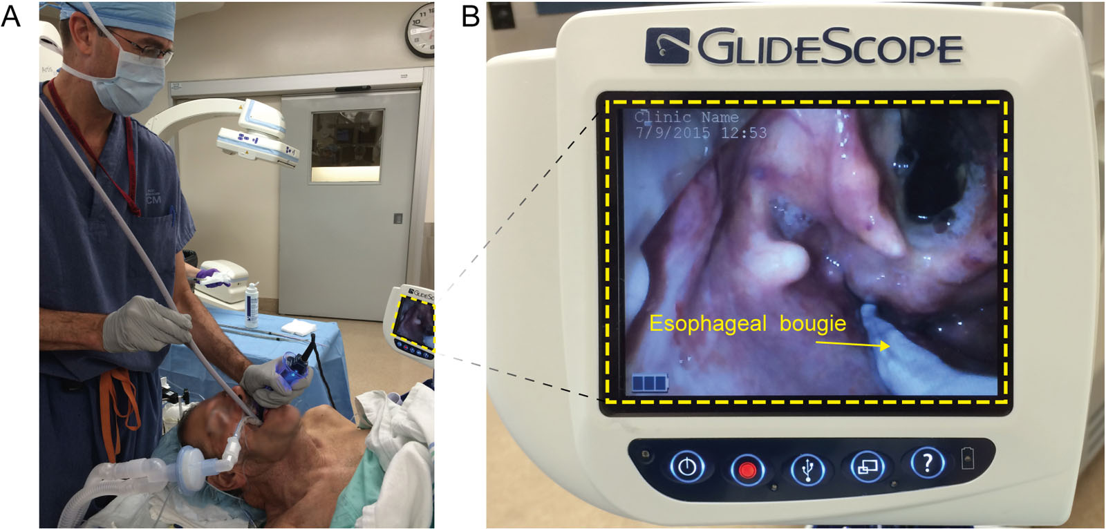 Esophageal dilatation. (A,B) Progressive esophageal dilatation using a bougie under direct visualization in a patient with esophageal strictures to allow the insertion of a transesophageal echocardiography probe. (Curtesy of Dr Georges Desjardins)
