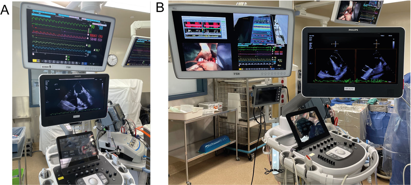 Intraoperative displays. Intraoperative displays of both TEE imaging with (A) hemodynamic monitoring, (B) dual hemodynamic and intraoperative imaging, or (C) multimodal cerebral, hemodynamic and intraoperative monitoring.<em> Abbreviations</em>: TEE, transesophageal echocardiography.<i class='fa fa-video-camera' aria-hidden='true'></i>