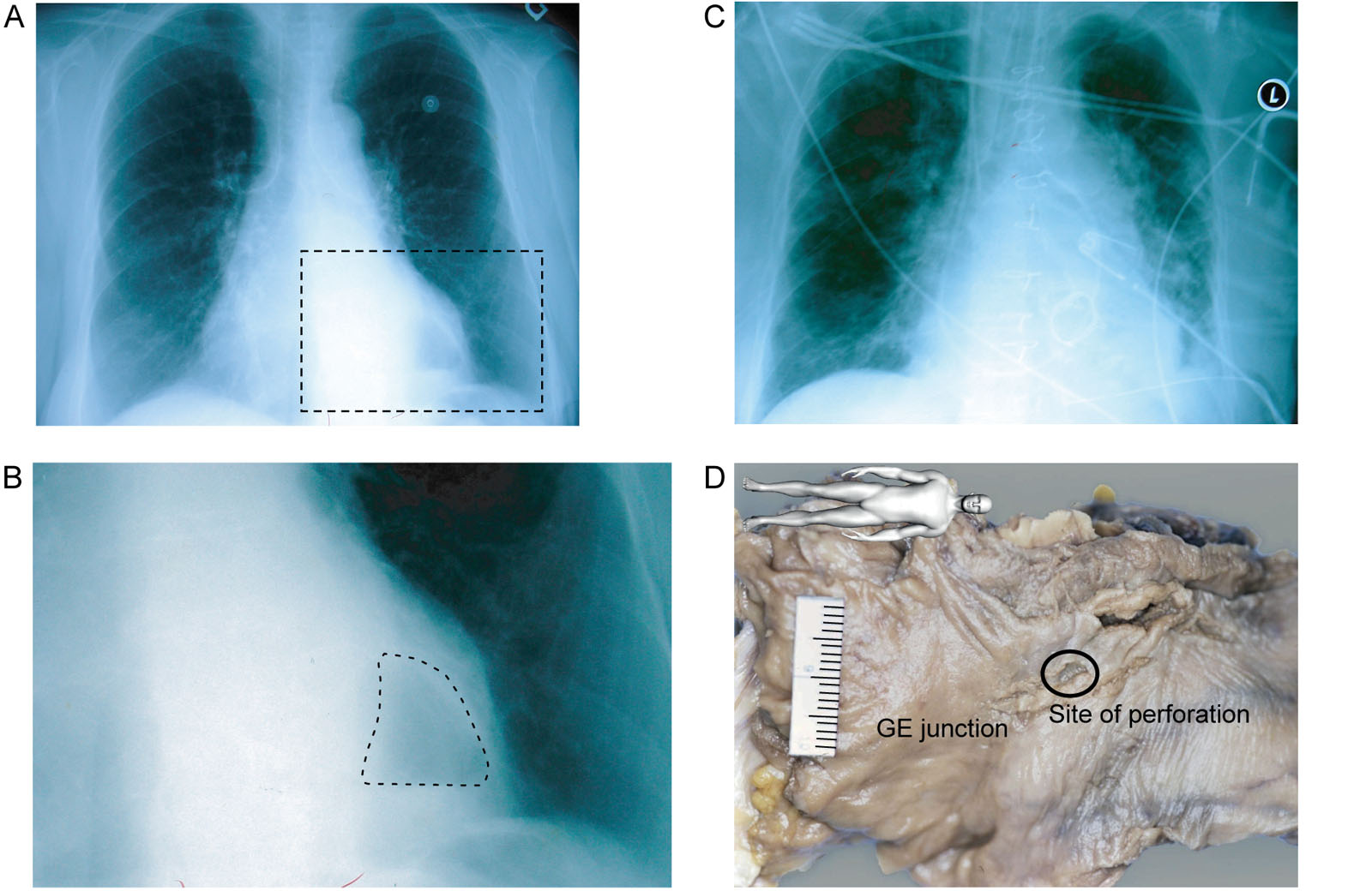 Distal esophageal perforation. A 71-year-old woman undergoes AoV and MV replacement with TEE monitoring. (A,B) Her preoperative chest X-ray shows a hiatal hernia (dotted line). (C) In the postoperative period, she developed a left-sided pneumothorax and pleural effusion requiring a chest tube. She then went into multi-organ failure and died. (D) The autopsy showed distal esophageal perforation and a posterior mediastinal abscess.<em> Abbreviations</em>: AoV, aortic valve; GE, gastroesophageal; L, left; MV, mitral valve; TEE, transesophageal echocardiography. Source: Photo D courtesy of Dr. Tack Ki Leung.