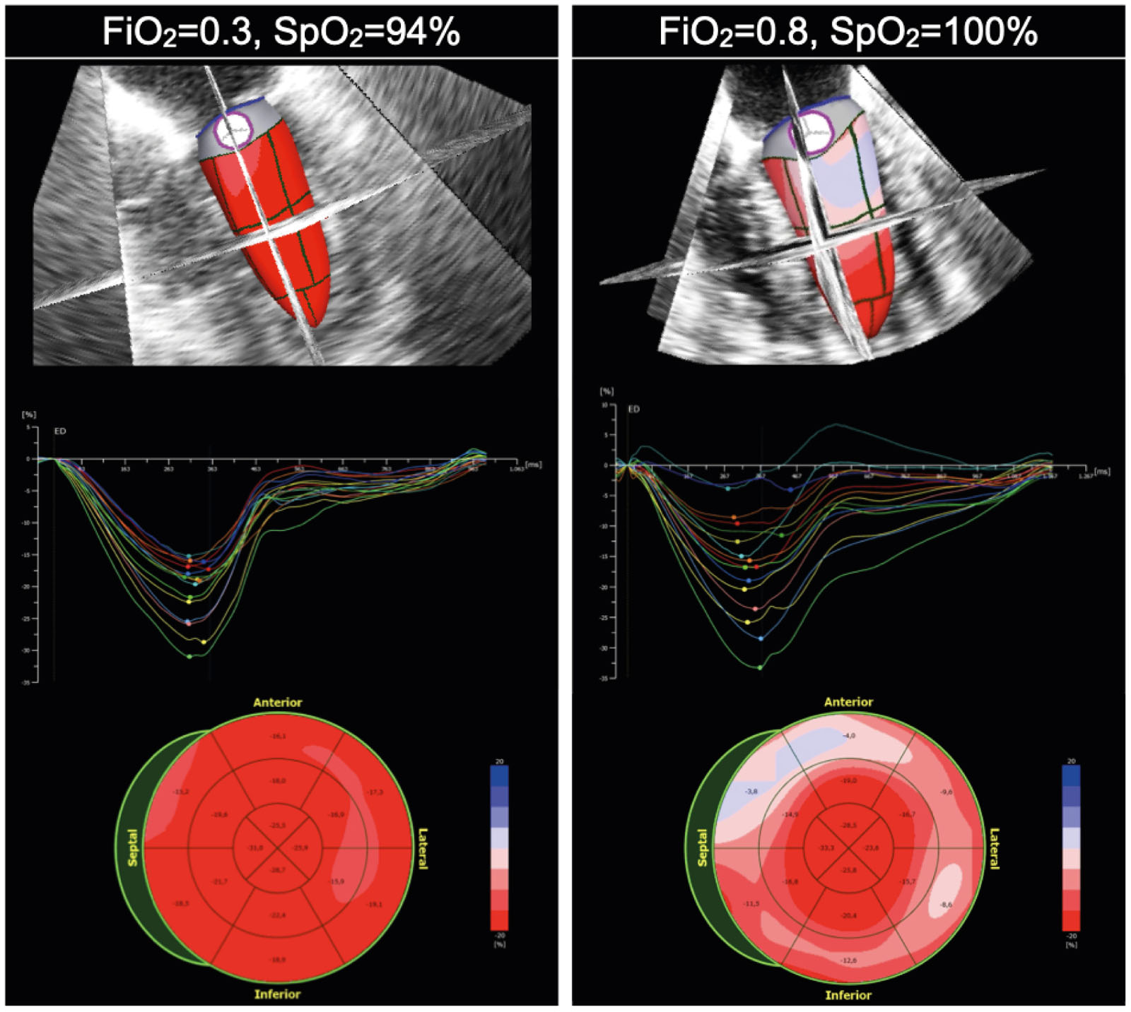 Strain in hyperoxia. In patients with normal contractile function, hyperoxia may be associated with a decrease in systolic function and changes in regional wall motion, as seen in these strain curves and bull’s eyes when increasing the FiO<sub>2</sub> from 30% to 80%.<em> Abbreviations</em>: FiO<sub>2</sub>, inspired oxygen concentration; SpO<sub>2</sub>, oxygen saturation using pulse oximetry.