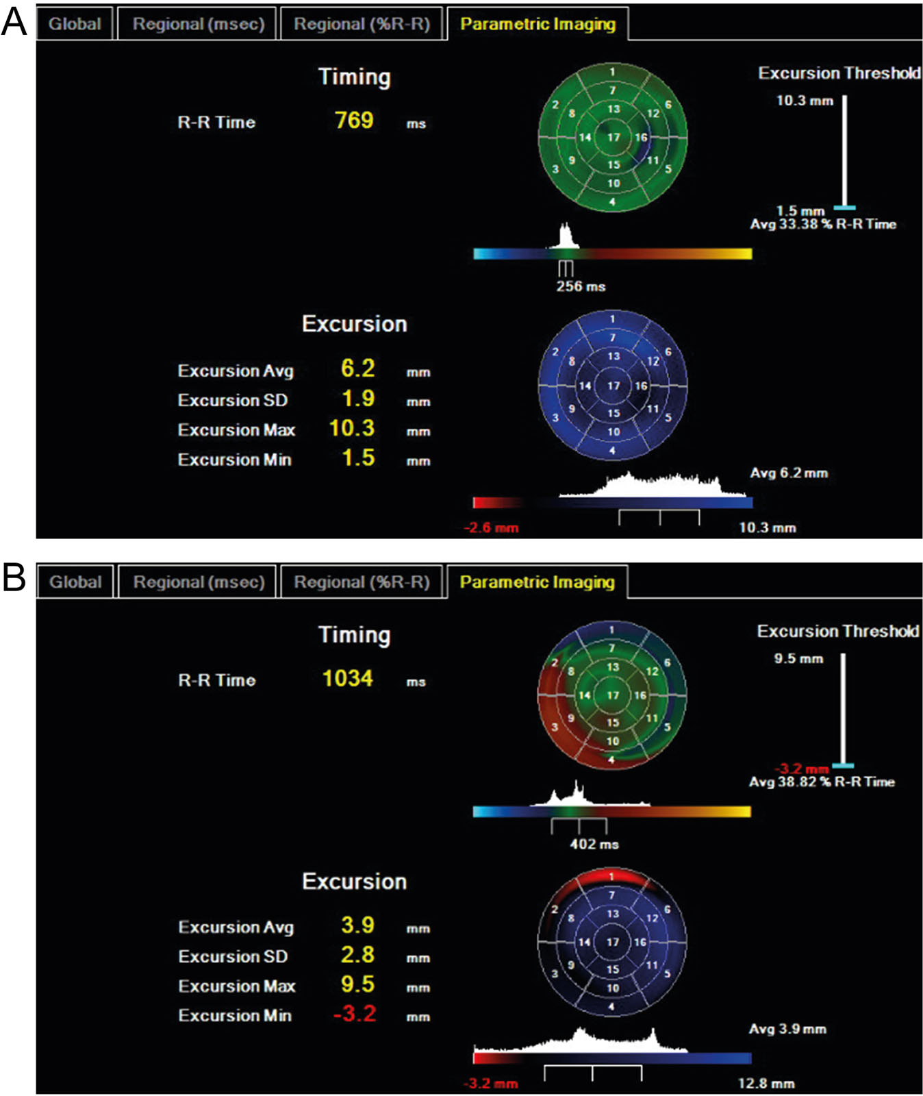 LV timing and excursion. Real time three-dimensional echocardiography analysis showing (A) normal and (B) abnormal bull’s-eye parametric displays of regional timing and excursion in a TTE orientation. For timing, the green color indicates average timing, blue color, early contraction and red color, delayed contractions. For excursion, the blue color indicates normal inward motion; black color is an akinetic segment and red is dyskinetic segments.<em> Abbreviations</em>: Avg, average; LV, left ventricle; SD, standard deviation; TTE, transthoracic echocardiography. . Adapted from Aggarwal et al.<strong><sup>33</sup></strong>