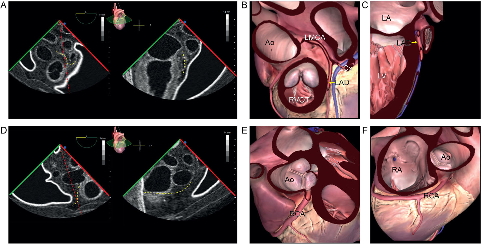Biplane coronary views 0° and 90°. (A-H) ME biplane views and diagrams at 0° and 90° using a TEE simulator with a focus on the (A-D) LCA and (E-H) RCA.<em> Abbreviations</em>: Ao, aorta; LA, left atrium; LAD, left anterior descending; LCA, left coronary artery; LCx left circumflex artery; LMCA, left main coronary artery; LV, left ventricle; ME, mid-esophageal; RA, right atrium; RCA, right coronary artery; RVOT, right ventricular outflow tract; TEE, transesophageal echocardiography. <i class='fa fa-video-camera' aria-hidden='true'></i>