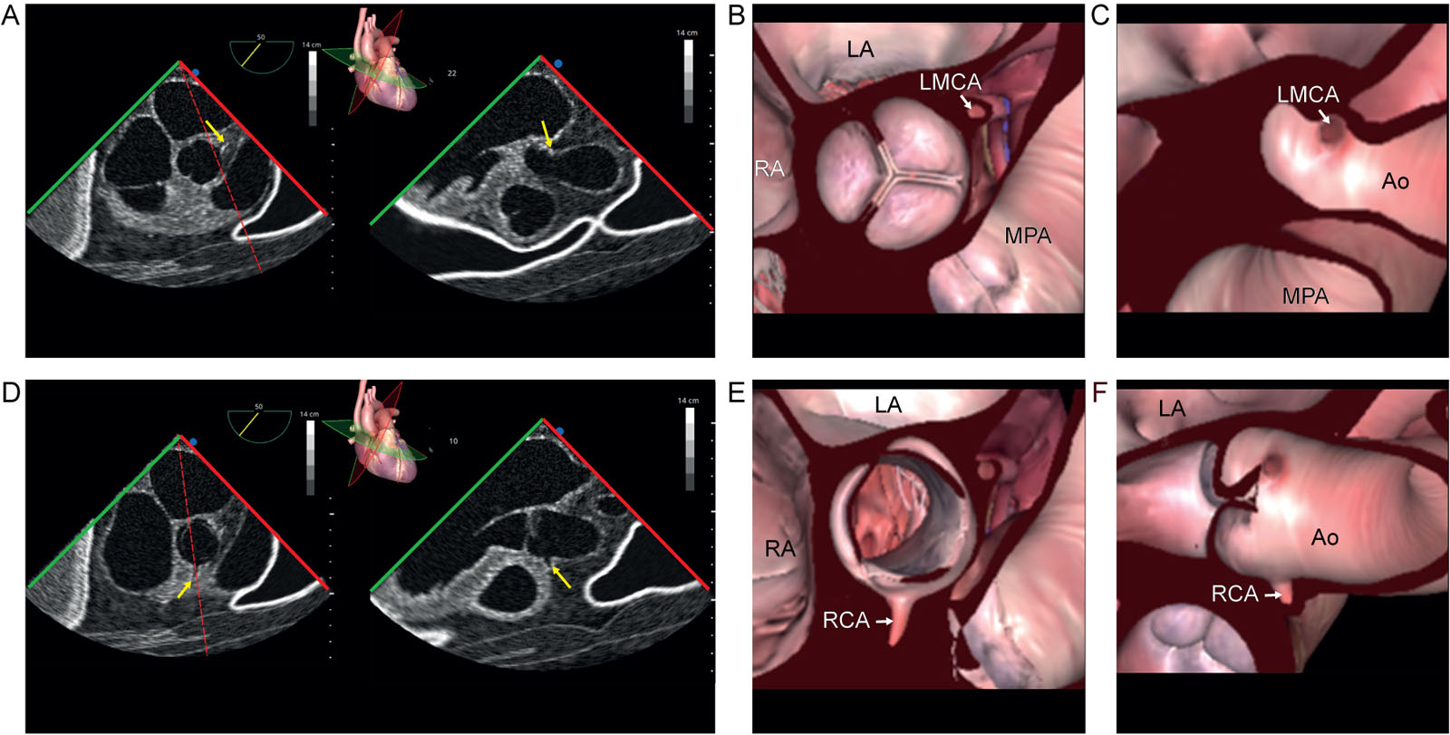 Biplane coronary views 50° and 140°. (A-H) ME biplane views and diagrams at 50° in SAX and 140° in LAX using a TEE simulator with a focus on the origins of the (A-D) LCA and (E-H) RCA.<em> Abbreviations</em>: Ao, aorta; LA, left atrium; LAX, long-axis; LCA, left coronary artery; LMCA, left main coronary artery; ME, mid-esophageal; MPA, main pulmonary artery; RA, right atrium; RCA, right coronary artery; SAX, short-axis; TEE, transesophageal echocardiography. <i class='fa fa-video-camera' aria-hidden='true'></i>