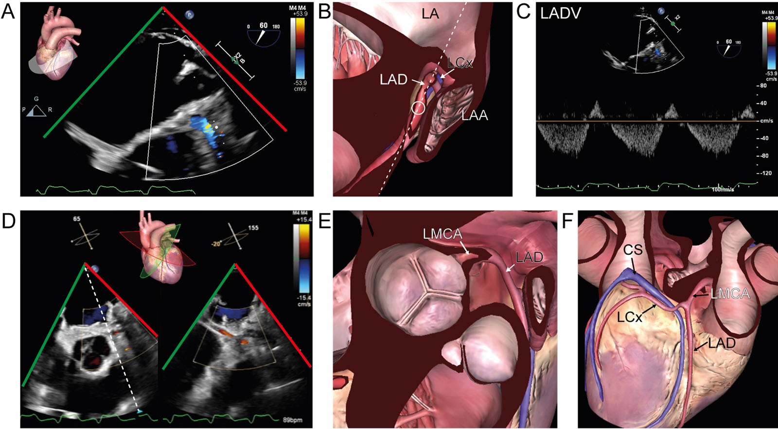 Coronary anatomy. (A, B) ME view at 60° with CFI in a 63-year-old woman after return on CPB for an inadequate LAD Doppler signal. (C) The PWD signal of the LAD has a predominantly normal diastolic velocities (normal: 71±19 cm/s). However, there is abnormal systolic reversal as cardiac function recovers from CPB. (D-F) ME AoV biplane view with CFI in a 59-year-old man after cardiac transplantation and graft failure. The LCx artery appears in both views with a normal CFI signal.<em> Abbreviations</em>: AoV, aortic valve; CFI, color flow imaging; CPB, cardiopulmonary bypass; CS, coronary sinus; LA, left atrium; LAA, left atrial appendage; LAD, left anterior descending; LADV, left anterior descending velocity; LCx, left circumflex; LMCA, left main coronary artery; ME, mid-esophageal; PWD, pulsed-wave Doppler. <i class='fa fa-video-camera' aria-hidden='true'></i>