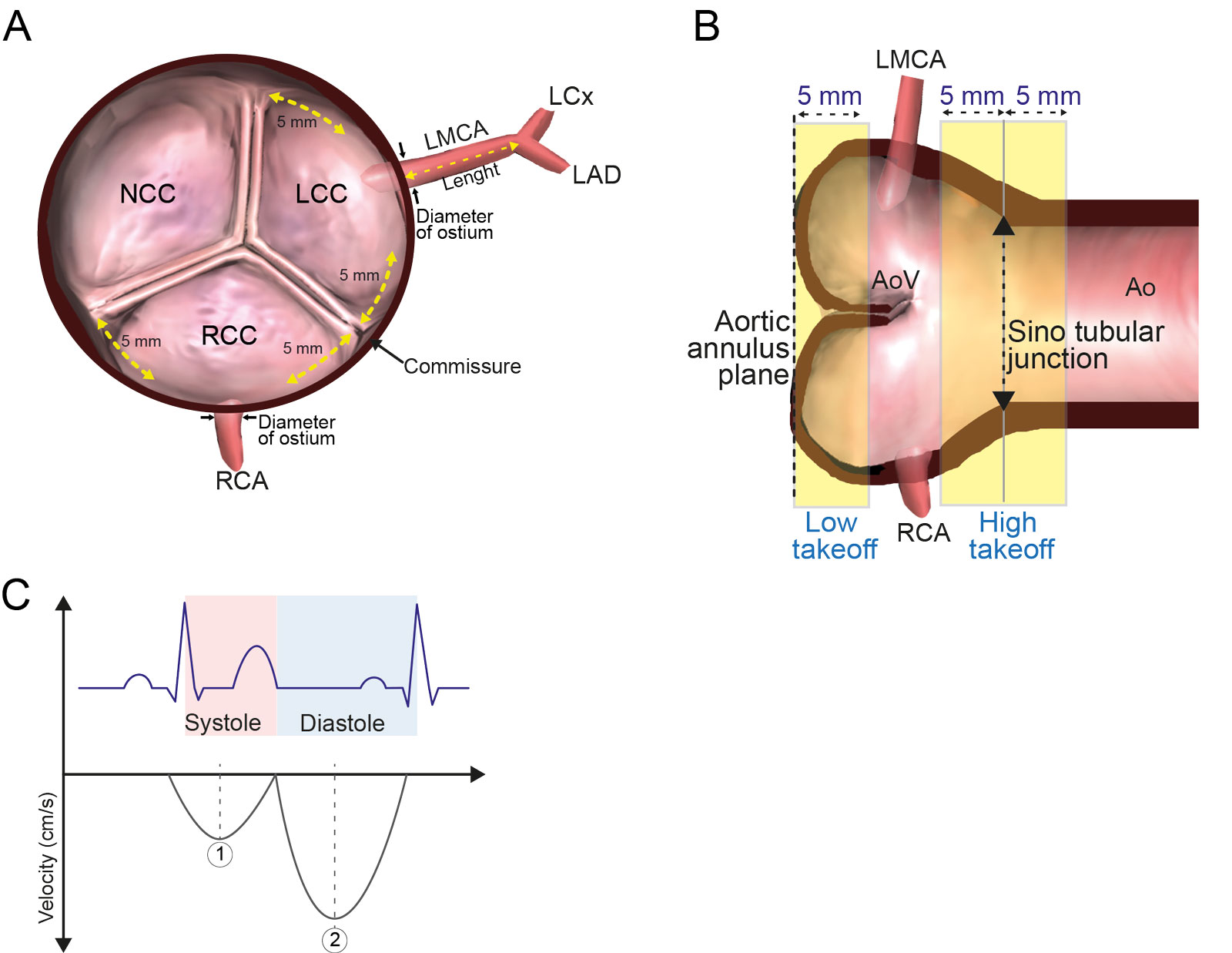 Coronary artery measurements. These schematic diagrams show the TEE findings and measurement criteria for coronary arteries. (A) Diagram of the ME AoV SAX view shows the location of anomalous origin and measurements of the LMCA length and the LMCA and RCA ostial diameters. The coronary origin was defined as anomalous if it was located within 5 mm of the commissure in the ME AoV SAX view. (B) Diagram of the ME AoV LAX view illustrating low and high orifice takeoff relative to the aortic annulus and STJ. Low takeoff was defined as within 5 mm from the annulus, whereas high takeoff was defined as within 5 mm below or above the STJ. (C) Schematic of normal coronary flow spectral envelope presenting as a continuous flow with diastolic predominance relative to the ECG and cardiac cycle.<em> Abbreviations</em>: Ao, aorta; AoV, aortic valve; ECG, electrocardiographic; LAD, left anterior descending artery; LAX, long-axis; LCC, left coronary cusp; LCx, left circumflex artery; LMCA, left main coronary artery; ME, mid-esophageal; NCC, non-coronary cusp; RCA, right coronary artery; RCC, right coronary cusp; SAX, short-axis; STJ, sinotubular junction; TEE, transesophageal echocardiography. Modified from Kasprzak <strong><sup>59</sup></strong> and Kondo et al. <strong><sup>57</sup></strong> and Kasprzak et al.