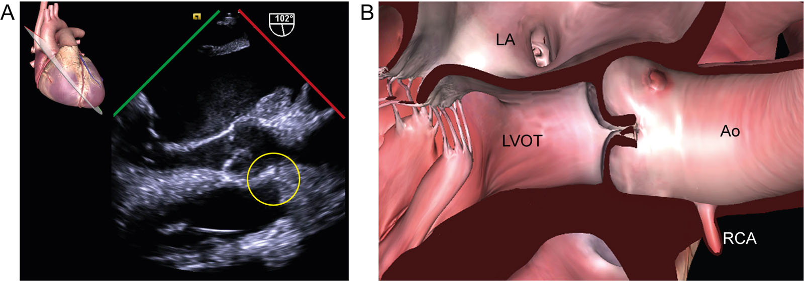 Anomalous coronary artery. (A, B) ME AoV LAX view from a 73-year-old female patient with rheumatic mitral stenosis without known congenital anomalies or connective tissue disease. There is an abnormal origin of the RCA above the STJ (yellow circle). In such cases, the surgeon needs to use caution to avoid coronary steal while de-airing through the Ao-root vent and coronary obstruction (or kinking) by pledget reinforcement sutures.<em> Abbreviations</em>: Ao, aorta; AoV, aortic valve; LA, left atrium; LAX, long-axis; LVOT, left ventricular outflow tract; ME, mid-esophageal; RCA, right coronary artery; STJ, sinotubular junction. <i class='fa fa-video-camera' aria-hidden='true'></i>