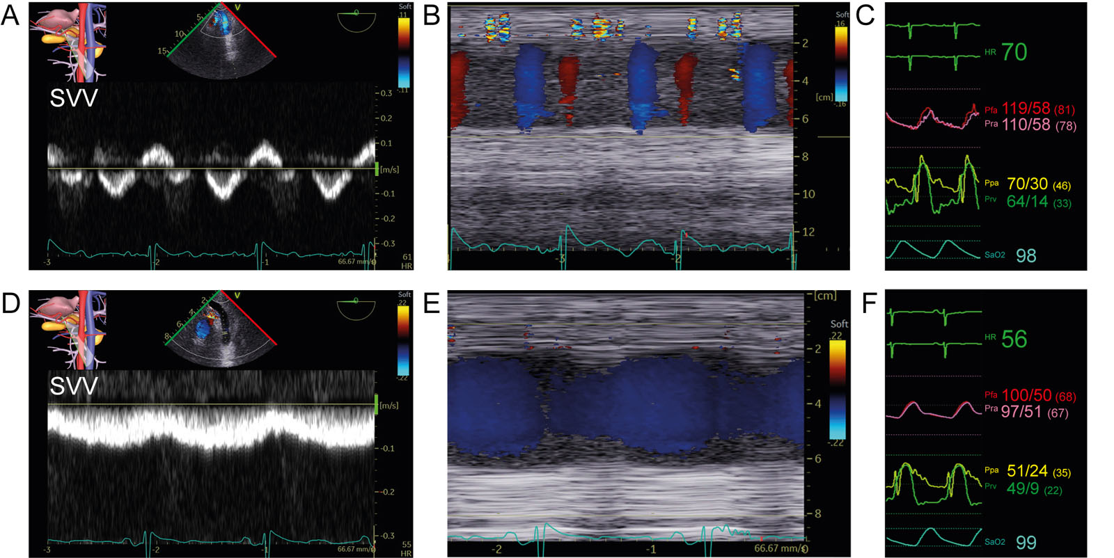 Abnormal SVV and response to inhaled agents. (A, B) TGAUS view of the splenic vein with (A) PWD of splanchnic vein velocity and (B) CFI and M-mode imaging in a patient before revascularization, AoV replacement and aortic surgery. (C) The abnormal biphasic portal pulsatility in A was associated with severe PHT (Ppa 70/30mmHg). (D, E) Significant reduction in portal vein pulsatility appears after a (F) reduction in PHT (Ppa 51/24mmHg) and normalization of the diastolic Prv to 9mmHg following inhaled prostacyclin and milrinone.<em> Abbreviations</em>: AoV, aortic valve; CFI, color flow imaging; HR, heart rate; Pfa, femoral arterial pressure; PHT, pulmonary hypertension; Ppa, pulmonary artery pressure; Pra, radial arterial pressure; Prv, right ventricular pressure; PWD, pulsed-wave Doppler; SaO<sub>2</sub>, oxygen saturation; SVV, splenic vein velocity; TGAUS, transgastric abdominal ultrasound.