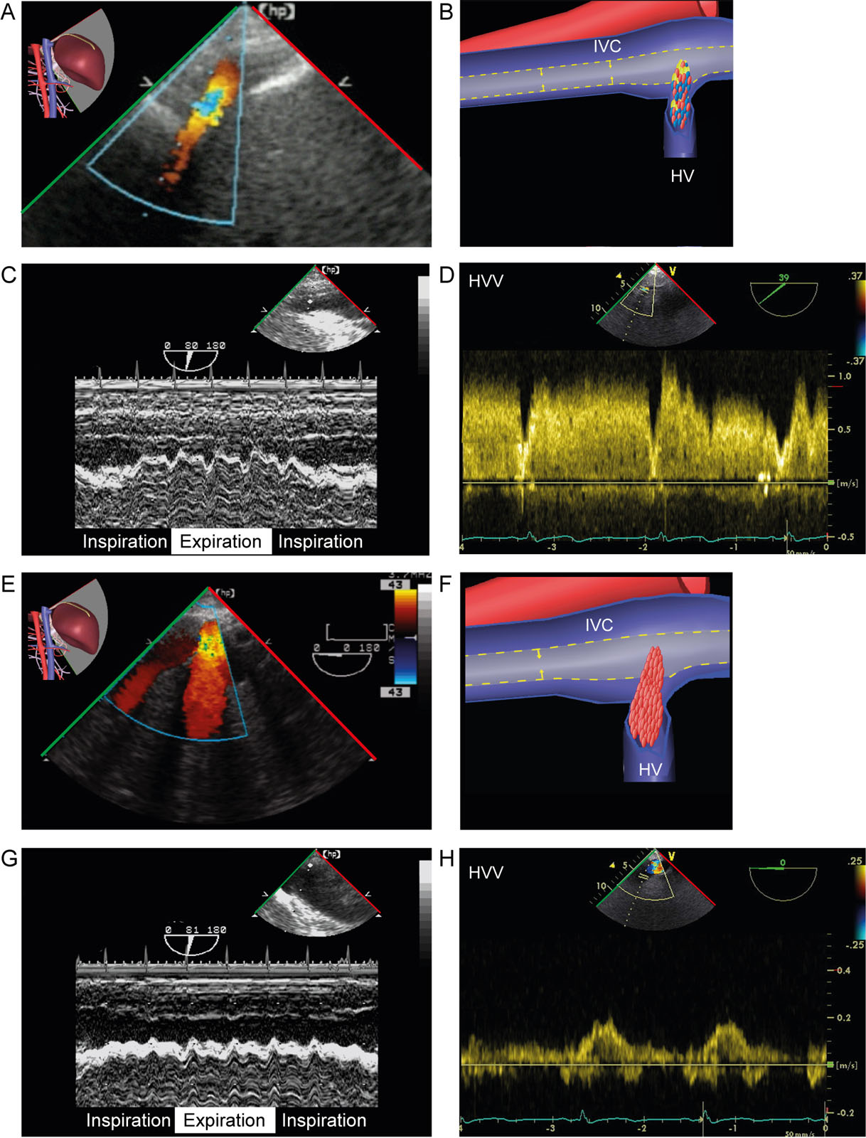 Preload reduction. (A, B) TGAUS LAX IVC view with CFI shows reduced preload from hypovolemia as evidenced by both a reduced size of the IVC and hepatic veins, as well as (C) collapse during expiration while supported on mechanical ventilation using M-mode and (D) elevated HVV by PWD. (E-H) Following a fluid challenge both (E, F) the size of the IVC and hepatic veins enlarge, (G) IVC collapsibility decreases on M-mode and (H) the HVV normalizes.<em> Abbreviations</em>: CFI, color flow imaging; HV, hepatic vein; HVV, hepatic vein velocities; IVC, inferior vena cava; LAX, long-axis; PWD, pulsed-wave Doppler; TGAUS, transgastric abdominal ultrasound. <i class='fa fa-video-camera' aria-hidden='true'></i>