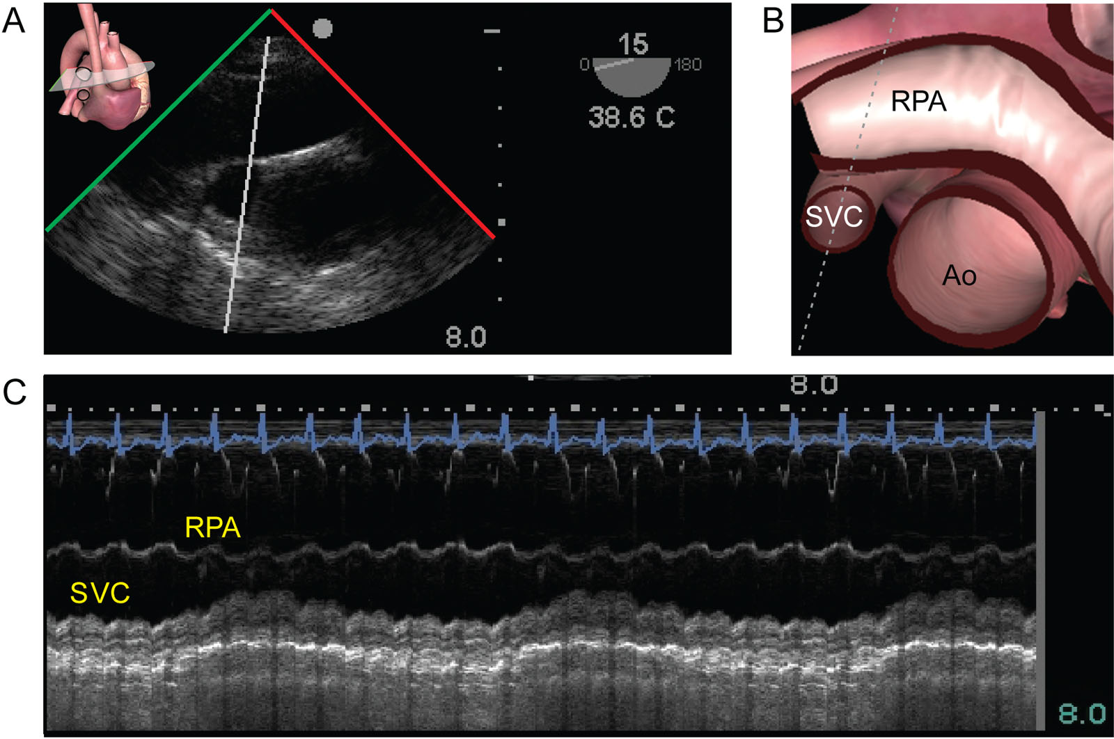 SVC respiratory variations. (A,B, C) ME ascending aorta SAX view in a patient in the intensive care unit after the removal of 1.8 liters using dialysis shows significant respiratory variation of the SVC. Using M mode, phasic variations of the diameter of the SVC can be objectified.<em> Abbreviations</em>: Ao, aorta; ME, mid-esophageal; RPA, right pulmonary artery; SAX, short-axis; SVC, superior vena cava. <i class='fa fa-video-camera' aria-hidden='true'></i>