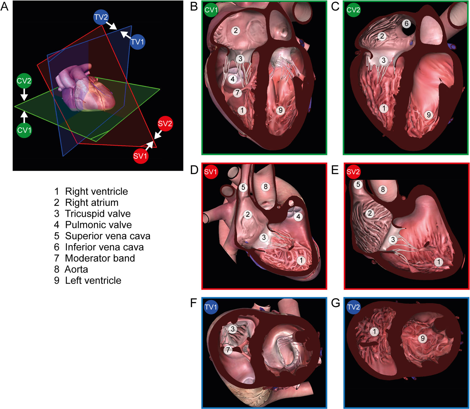 2D, two-dimensional; 3D RV views. (A) 3D MPR planes with (B, C) coronal views (green CV1 and CV2), (D, E) sagittal views (red SV1 and SV2) and (F, G) transverse views (blue TV1 and TV2). The images planes are the same on 2D but on 3D a different perspective will be seen depending on which position (1 or 2) of the heart is displayed.<em> Abbreviations</em>: 3D, three-dimensional; MPR, multiplane reconstruction; RV, right ventricle.