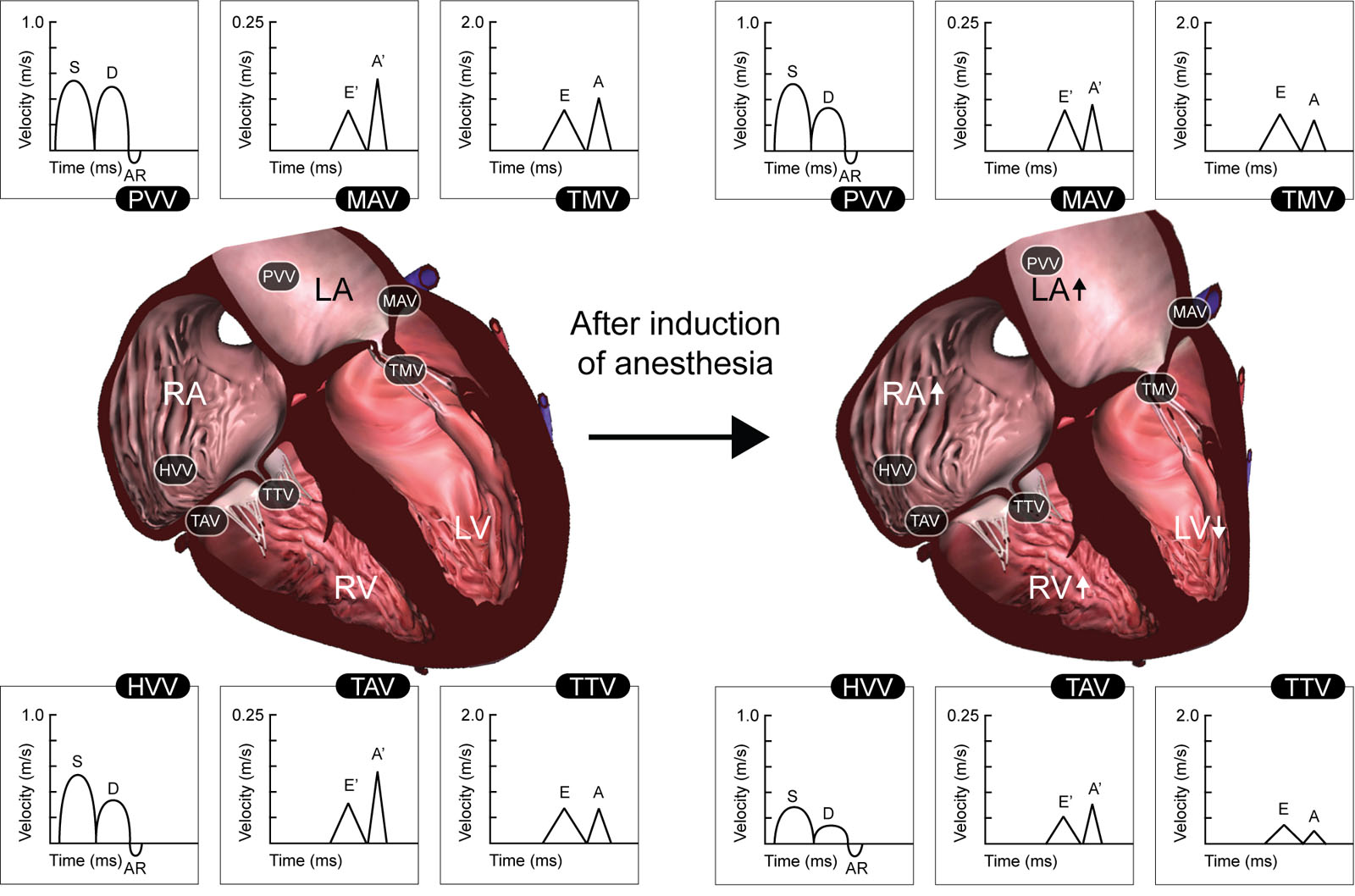 Effect of anesthesia on cardiac function. This diagram summarizes the changes in cardiac dimensions and biventricular filling patterns after the induction of anesthesia. Presented are velocities for TMV and TTV peak early (E) and peak late (A) diastolic flow, HVV and PVV peak S, D, and AR flow, and MAV and TAV peak early (E<sup>;</sup>) and peak late (A′) diastolic flow.<em> Abbreviations</em>: AR, peak atrial reversal velocity; D, peak diastolic velocity; HVV, hepatic venous velocity; LA, left atrium; LV, left ventricle; MAV, mitral annulus velocity; PVV, pulmonary venous velocity; RA, right atrium; RV, right ventricle; S, peak systolic velocity; TAV, tricuspid annulus velocity; TMV, transmitral velocity; TTV, trans-tricuspid velocity. Adapted from Couture et al. <strong><sup>262</sup></strong>
