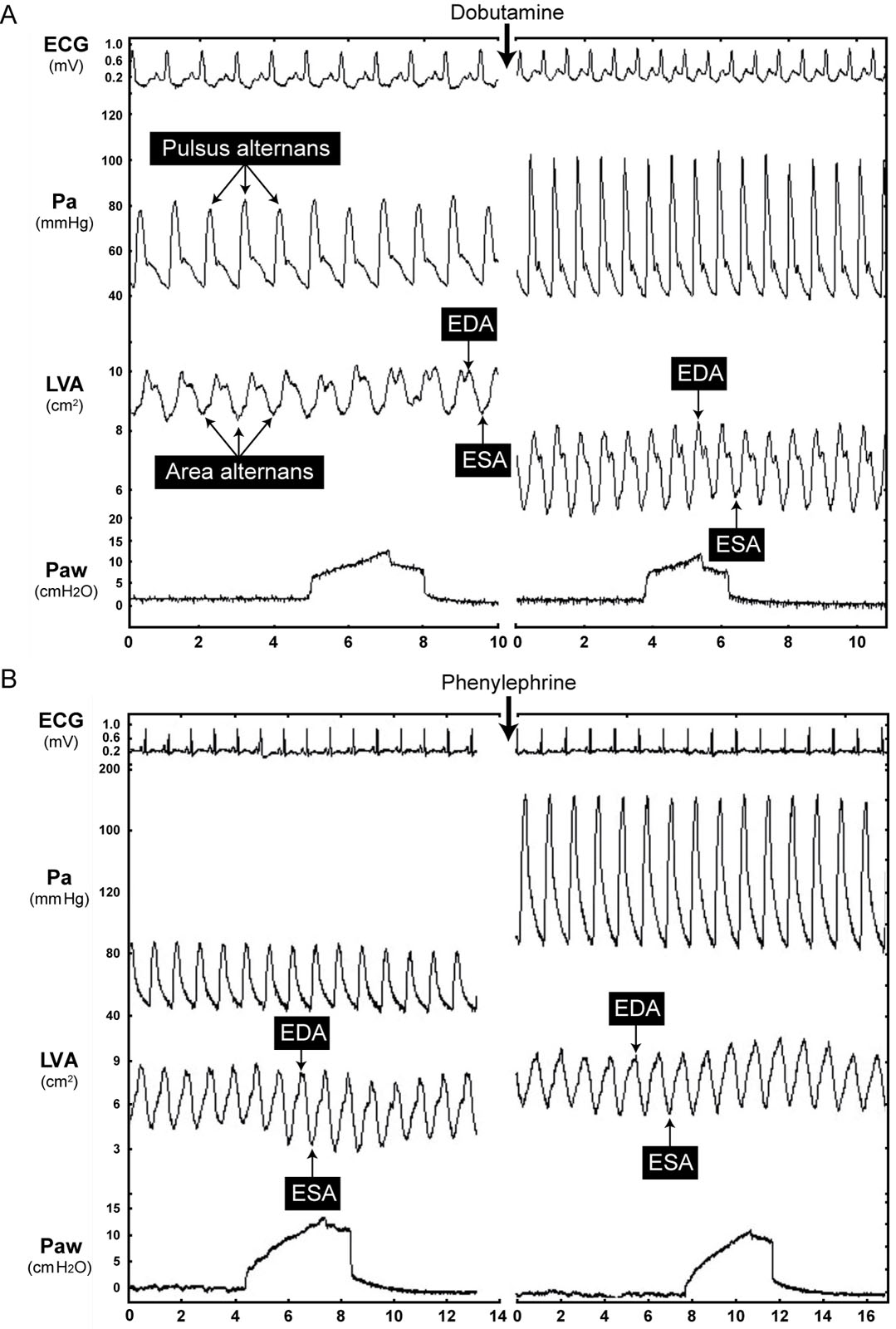 Vasoactive agents. Diagrams showing the effectiveness of vasoactive agents on hemodynamic and echocardiographic parameters. (A) Dobutamine increases HR and Pa, decreases EDA and ESA with a significant increase in SA (SA = EDA–ESA) and in FAC (FAC = EDA–ESA/EDA). Pulsus alternans and area alternans disappear after administering dobutamine. (B) Phenylephrine administration did not change HR, increases Pa, EDA and ESA with no significant change in SA (SA = EDA - ESA) and in FAC (FAC = (EDA–ESA)/EDA). Continuous LVA tracing displays occurred by automated border detection using acoustic quantification.<em> Abbreviations</em>: ECG, electrocardiogram; EDA, end-diastolic area; ESA, end-systolic area; FAC, fractional area change; HR, heart rate; LVA, left ventricular area; Pa, arterial pressure; Paw, airway pressure; SA stroke area. Source: Courtesy of Dr. Michael R. Pinsky. <i class='fa fa-video-camera' aria-hidden='true'></i>