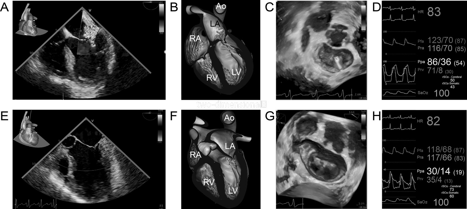 Inhaled prostacyclin and milrinone cardiac effects. (A-C) ME 4C with CFI shows severe MR, confirmed by 3D en-face MV view, before inhaled epoprostenol and inhaled milrinone (iE&iM) administration. (D) There is elevation of Ppa (86/36 mmHg) and the regional brain oxygen saturation (rSO<sub>2</sub>) is left 50% and right 43%. (E-G) 30 minutes after iE&iM (60 ug and 4 mg), there is a significant reduction in MR, (E, F) in the ME 4C with CFI and (G) the 3D en-face MV views. (H) Hemodynamic waveforms 18 minutes after iE&iM administration show a significant reduction in the Ppa from 86/36mmHg to 30/4mmHg without significant changes in systemic arterial pressure (Pfa and Pra) and an increase in rSO<sub>2</sub>.<em> Abbreviations</em>: 3D, three-dimensional; 4C, four-chamber; Ao, aorta; CFI, color flow imaging; HR, heart rate; LA, left atrium; LV, left ventricle; ME, mid-esophageal; MR, mitral regurgitation; MV, mitral valve; Pfa, femoral arterial pressure; Ppa, pulmonary artery pressure; Pra, radial arterial pressure; Prv, right ventricular pressure; RA, right atrium; RV, right ventricle; SaO<sub>2</sub>, oxygen saturation. Adapted from Elmi Sarabi et al. <strong><sup>285</sup></strong><i class='fa fa-video-camera' aria-hidden='true'></i>