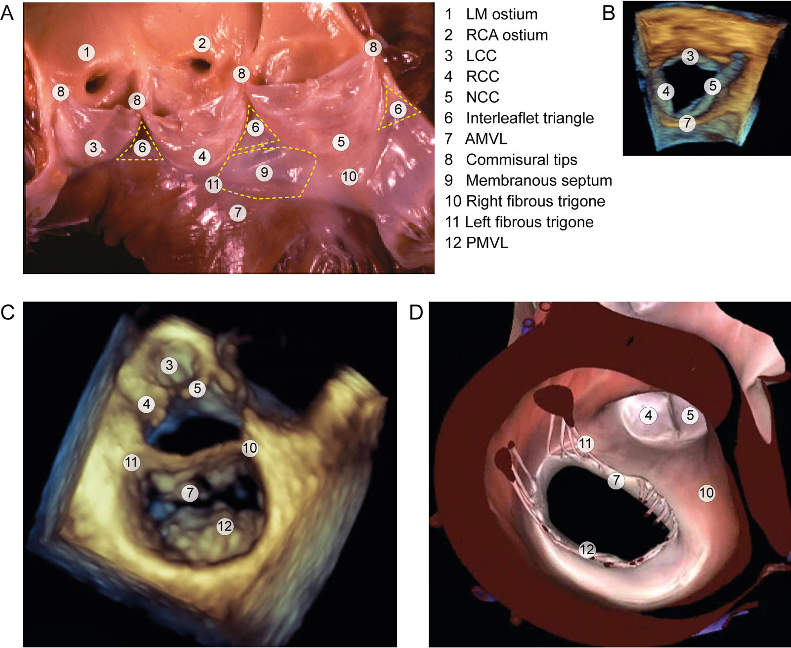LVOT anatomy. (A) Anatomical aspect of the LVOT. The LVOT includes an anterior wall comprising the interventricular septum and membranous septum and a posterior wall, including the mitro-aortic curtain and the AMVL. The left and right trigone attach both the anterior and posterior walls and acts as a hinge mechanism for subaortic curtain movement (B-D) 3D anatomy of the LVOT from a ventricular view.<em> Abbreviations</em>: 3D, three-dimensional; AMVL, anterior mitral valve leaflet; LCC, left coronary cusp; LM, left main; LVOT, left ventricular outflow tract; NCC, non-coronary cusp; PMVL, posterior mitral valve leaflet; RCA, right coronary artery; RCC, right coronary cusp. <i class='fa fa-video-camera' aria-hidden='true'></i>