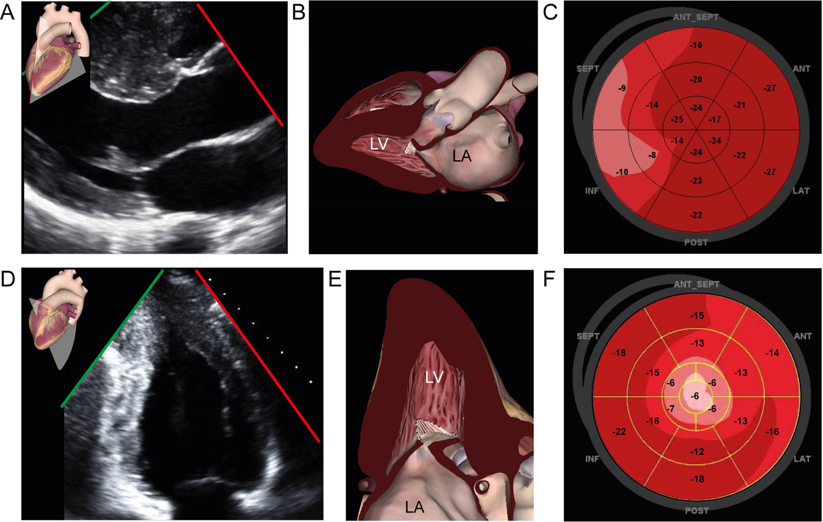 Regional strain in HCM. (A-C) A patient with septal HCM has this (A, B) TTE parasternal LAX view and corresponding (C) GLS polar map showing reduced strain in the basal septum. (D-F) A patient with apical HCM has this (D, E) TTE apical 2C view and corresponding (F) GLS strain polar map showing reduced strain in the apex.<em> Abbreviations</em>: 2C, two-chamber; 2D, two-dimensional; GLS, global longitudinal strain; HCM, hypertrophic cardiomyopathy; LA, left atrium; LAX, long-axis; LV, left ventricle, TTE, transthoracic echocardiography. Adapted from Nagueh et al.<strong><sup>10</sup></strong>