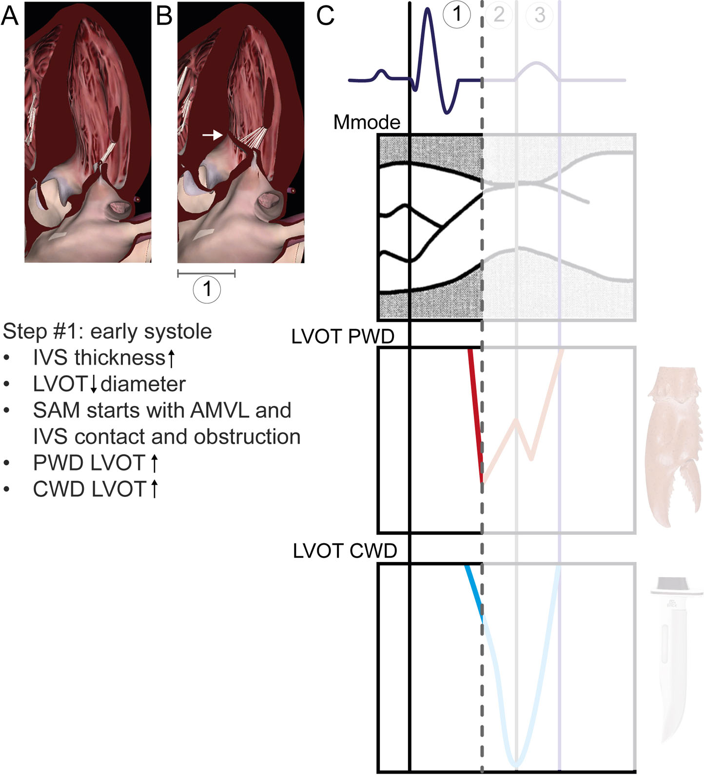 Temporal relations between ECG, M-mode and Doppler profiles in HCM #1. The time intervals related to the ECG are: 1 = Q wave to mitral-septal contact, 2 = period of AMVL and IVS contact; 3 = release of AMVL and IVS contact. (1) In early systole, there is an increase in LV flow (PWD) and LVOT flow (CWD) velocities. As IVS thickness increases and the AMVL pushes toward the IVS, SAM begins until the AMVL and IVS contact each other.<em> Abbreviations</em>: AMVL, anterior mitral valve leaflet; CWD, continuous-wave Doppler; ECG, electrocardiogram; HCM hypertrophic cardiomyopathy; IVS, interventricular septum; LV, left ventricular; LVOT, left ventricular outflow tract; PWD, pulsed-wave Doppler; SAM, systolic anterior motion. Adapted from Sherrid et al. <strong><sup>12</sup></strong>