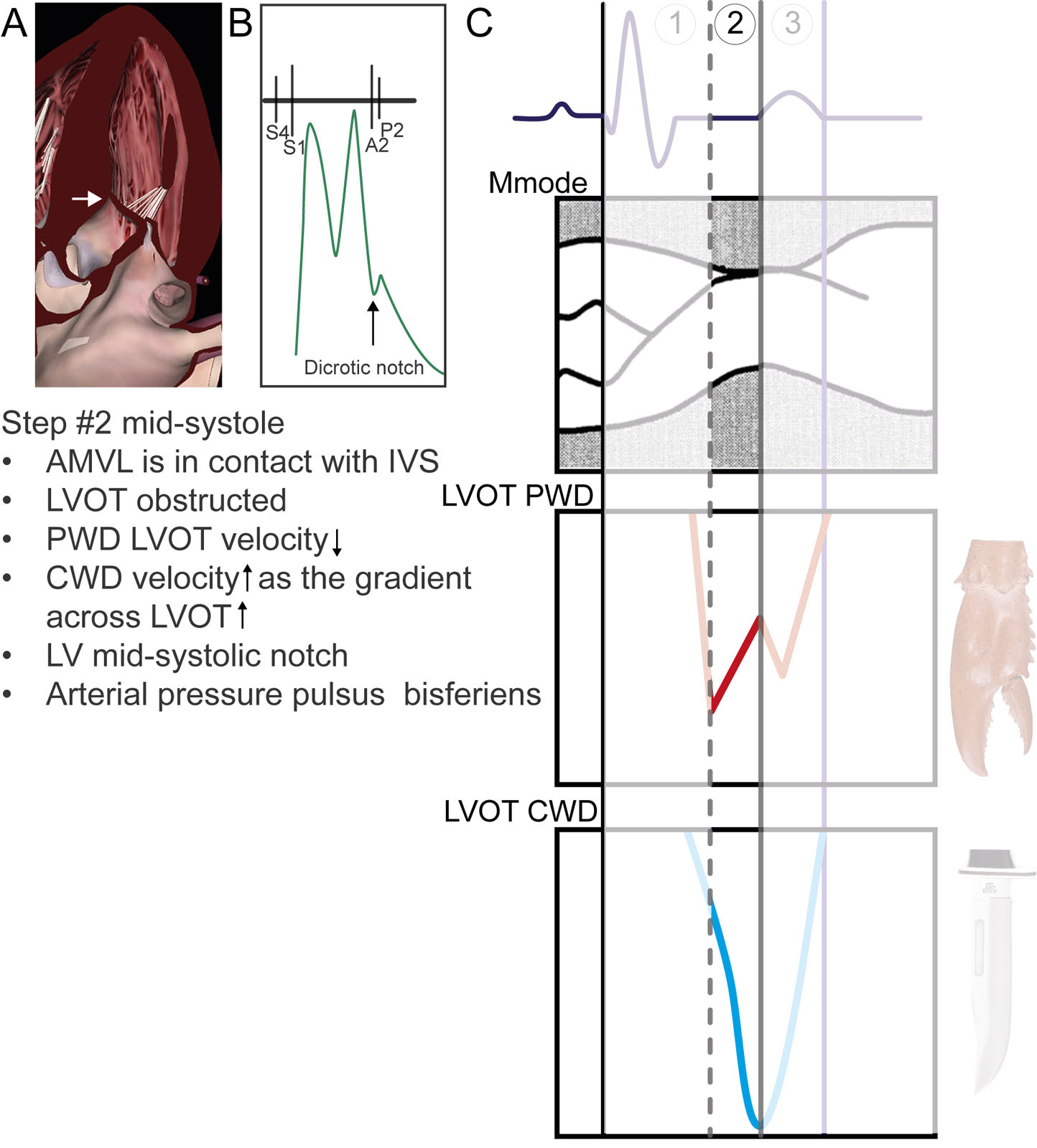 Temporal relations between ECG, M-mode and Doppler profiles in HCM #2. In mid-systole, the AMVL and IVS contact induces maximal LVOT flow obstruction, consequently, reducing upstream LV flow velocity (PWD) and increasing LVOT flow velocity (CWD). This period corresponds to the AoV mid-systolic notch and pulsus bisferiens on the arterial pressure. The dashed line is the relation between the timing of onsets of mitral septal contact and the LV early systolic velocity drop representing the first peak of the lobster claw. The straight line shows the temporal relation between mitral-septal contact, nadir of the LV velocity drop and peak LVOT velocity using CWD (bottom) or the first peak of the lobster claw.<em> Abbreviations</em>: AMVL, anterior mitral valve leaflet; AoV, aortic valve; CWD, continuous-wave Doppler; ECG, electrocardiogram; HCM hypertrophic cardiomyopathy; IVS, interventricular septum; LV, left ventricular; LVOT, left ventricular outflow tract; PWD, pulsed-wave Doppler. Adapted from Sherrid et al. <strong><sup>12</sup></strong>