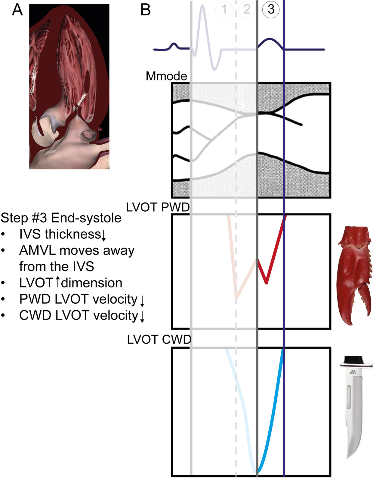 Temporal relations between ECG, M-mode and Doppler profiles in HCM #3. In end-systole, the IVS thickness decreases and the AMVL moves away from the IVS, reducing LVOT obstruction. As a result, upstream LV flow velocity initially increases (PWD), representing the second peak of the lobster claw and then decreases to zero as the LV cavity empties. As the LVOT dimension increases, the LV cavity empties, reducing LVOT flow velocity (CWD).<em> Abbreviations</em>: AMVL, anterior mitral valve leaflet; CWD, continuous-wave Doppler; ECG, electrocardiogram; HCM hypertrophic cardiomyopathy; IVS, interventricular septum; LV, left ventricular; LVOT, left ventricular outflow tract; PWD, pulsed-wave Doppler. Adapted from Sherrid et al. <strong><sup>12</sup></strong>