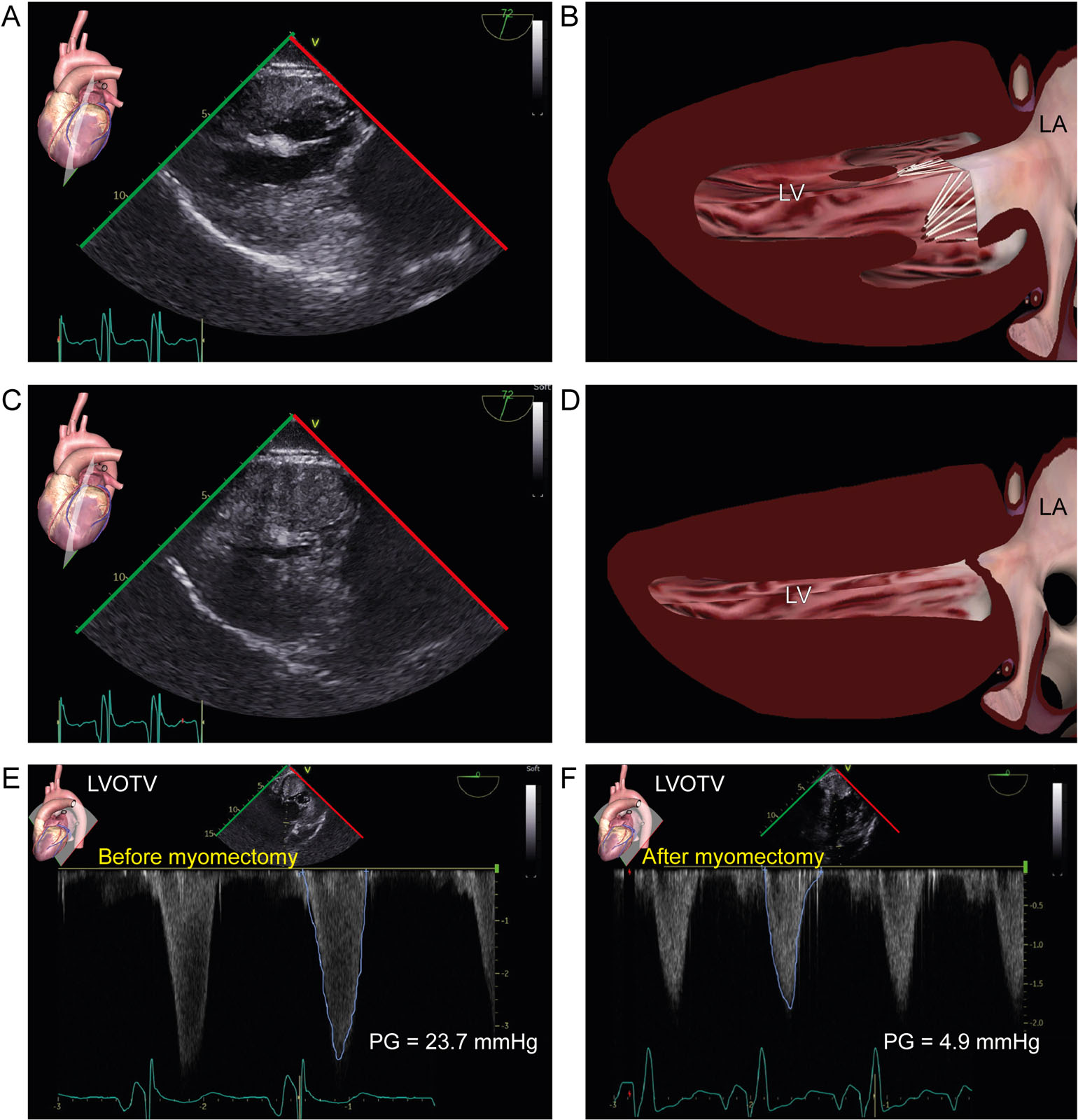 Diffuse HCM. TG 2C views in (A, B) diastole show diffuse LV hypertrophy and in (C, D) systole LV cavity obliteration in a 18-year-old woman with diffuse HCM. (E, F) After myomectomy, there was a significant reduction in the mean PG across the LVOT in the DTG views.<em> Abbreviations</em>: 2C, two-chamber; DTG, deep transgastric; HCM, hypertrophic cardiomyopathy; LA, left atrium; LV, left ventricular; LVOTV, left ventricular outflow tract velocity; PG, pressure gradient; TG, transgastric. <i class='fa fa-video-camera' aria-hidden='true'></i>
