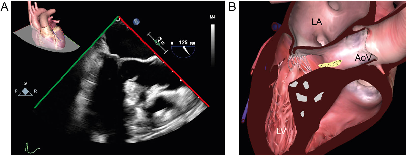 HCM and fibroelastoma. (A, B) ME LAX view in a 59-year-old woman with HCM shows increased zones of echogenicity of the IVS. In addition, there was an unexpected finding of a mobile mass in the LVOT attached to the IVS. Pathology confirmed that it was a fibroelastoma.<em> Abbreviations</em>: AoV, aortic valve; HCM, hypertrophic cardiomyopathy; IVS, interventricular septum; LA, left atrium; LAX, long-axis; LV, left ventricle; LVOT, left ventricular outflow tract; ME, mid-esophageal. <i class='fa fa-video-camera' aria-hidden='true'></i>