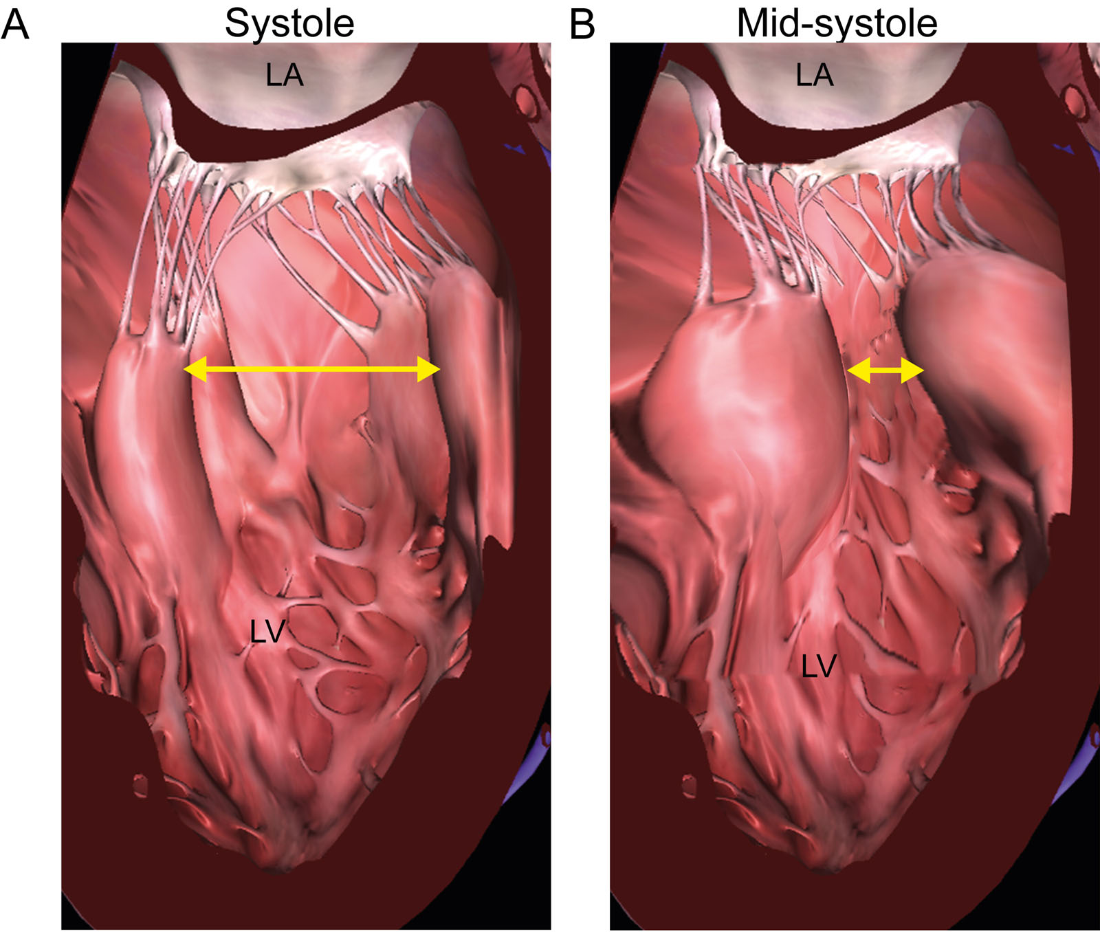 HCM and SAM. The diagrams of the mitral commissural view show how medial displacement of hypertrophied PMs promotes SAM of the AMVL. (A) This diagram shows normal PMs and chords attached to the AMVL. (B) In PM hypertrophy, there is a reduction in inter-PM distance from medial displacement, which decreases the distance between the PM tips and the AMVL A2 segment, selectively reducing central chordal tension.<em> Abbreviations</em>: AMVL, anterior mitral valve leaflet; HCM, hypertrophic cardiomyopathy; LA, left atrium; LV, left ventricle; LVOT, left ventricular outflow tract; PMs, papillary muscles; SAM, systolic anterior motion. Adapted from Silbiger et al.<strong><sup>44</sup></strong>