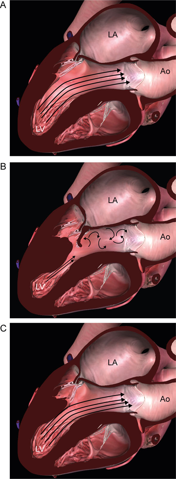 PM surgical release. Diagrams of the ME LAX view showing the effect of surgical release of the PMs. (A) This diagram shows normal PMs size and position with laminar LVOT flow. (B) Diagram showing hypertrophied anteriorly displaced PMs causing chordal slack allowing the AMVL to be swept into the LVOT, creating turbulent LVOT flow during LV ejection. (C) This diagram is after surgical trimming and release of the PMs from the underlying LV wall. This allows the mitral apparatus to assume a more physiologic posterior position, restoring laminar LVOT flow.<em> Abbreviations</em>: AMVL, anterior mitral valve leaflet; Ao, aorta; LA, left atrium; LAX, long-axis; LV, left ventricle; LVOT, left ventricular outflow tract; ME, mid-esophageal; PMs, papillary muscles. Adapted from Silbiger et al.<strong><sup>44</sup></strong>