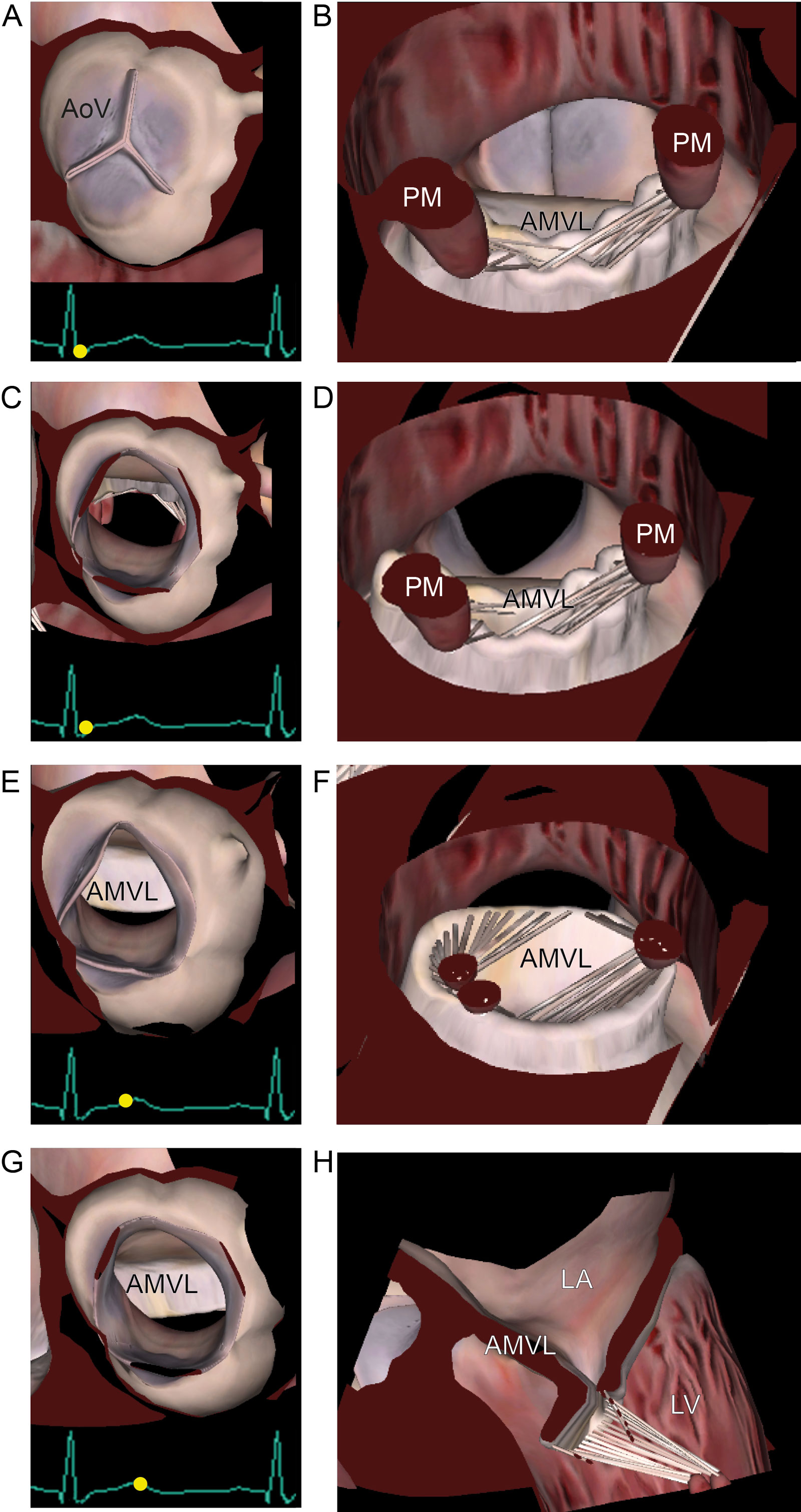 HCM and SAM. Schematic representation of (A-D) AoV valve view and (E-H) LVOT view of SAM. Reduction of AoV opening downstream the SAM in late-systole. Note the LVOT obstruction by the AMVL.<em> Abbreviations</em>: AMVL, anterior mitral valve leaflet; AoV, aortic valve; HCM, hypertrophic cardiomyopathy; LA, left atrium; LV, left ventricle; PMs, papillary muscles; SAM, systolic anterior motion. Adapted from Silbiger et al.<strong><sup>44</sup></strong> <i class='fa fa-video-camera' aria-hidden='true'></i>