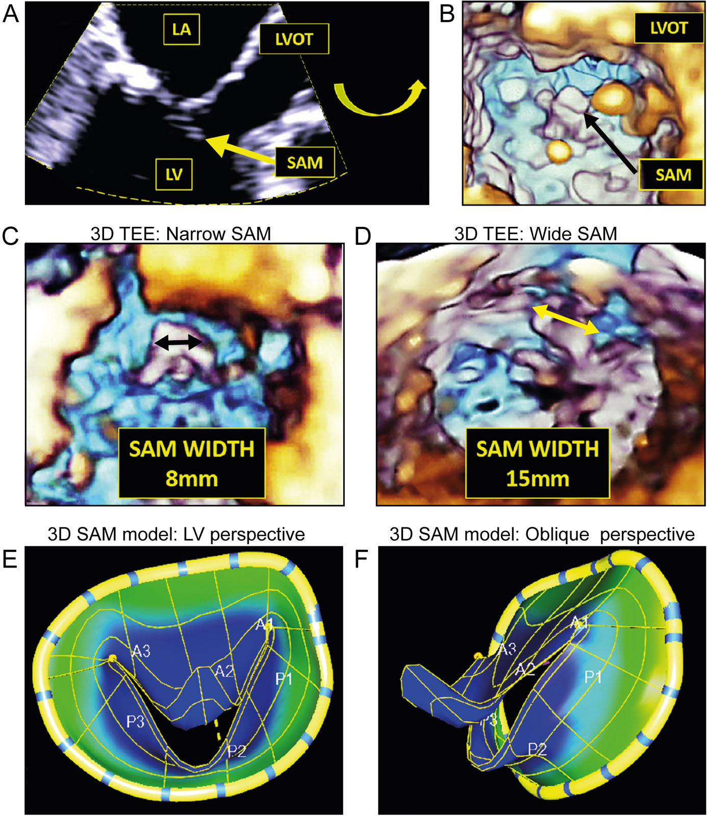 3D SAM ROI acquisition. (A) 2D ME AoV LAX view. The ROI for 3D zoom is represented by the dotted yellow line. Selecting the proper ROI is the critical first step for creating an optimal 3D image of SAM (yellow arrow). Note adequate depth to capture SAM and adequate azimuth width to capture full LVOT. (B) 3D of SAM and LVOT from LV perspective. Note the 3D image has been tilted upward to better reveal SAM and LVOT. (C) 3D TEE in SAM LVOT view demonstrating narrow SAM width of 8 mm. (D) 3D TEE in SAM LVOT view demonstrating wide SAM width of 15 mm. (E) 3D SAM model from LV/en face perspective. (F) 3D SAM model from an oblique perspective. This technology, available commercially using Esie Valves software (Siemens Healthineers), avoids 3D dropout and side lobe artifacts and creates static and dynamic models of SAM. Note the similarity with a Dolphin smile.<em> Abbreviations</em>: 2D, two-dimension; 3D, three-dimension; AoV, aortic valve; LA, left atrium; LAX, long-axis; LV, left ventricular; LVOT, left ventricular outflow tract; ME, mid-esophageal; ROI, region of interest; SAM, systolic anterior motion; TEE, transesophageal echocardiography. Adapted from Vainrib et al.<strong><sup>53</sup></strong>