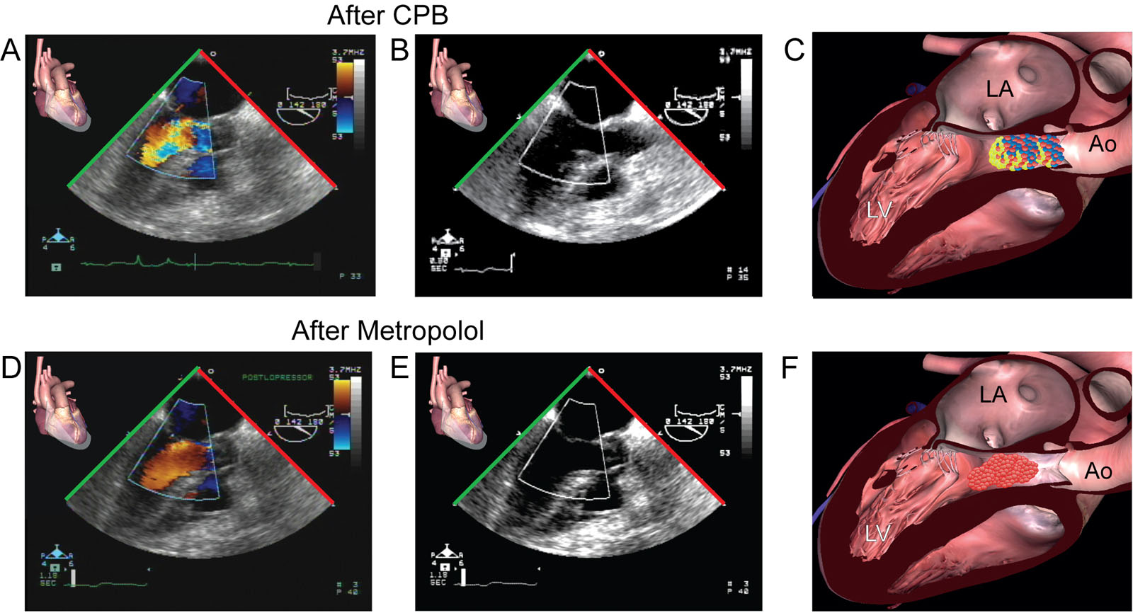 Metoprolol and LVOT obstruction. (A–C) ME LAX views with CFI show SAM with flow acceleration in the LVOT in a 63-year-old hemodynamically unstable woman immediately after CPB for coronary revascularization. (D–F) There was a clinical improvement after administrating an intravenous bolus of metoprolol with a reduction in CFI turbulence and increase cardiac dimension as a result of reduce heart rate.<em> Abbreviations</em>: Ao, aorta; CFI, color flow imaging; CPB, cardiopulmonary bypass; LA, left atrium; LAX, long-axis; LV, left ventricle; LVOT, left ventricular outflow tract; ME, mid-esophageal; SAM, systolic anterior motion.<i class='fa fa-video-camera' aria-hidden='true'></i>
