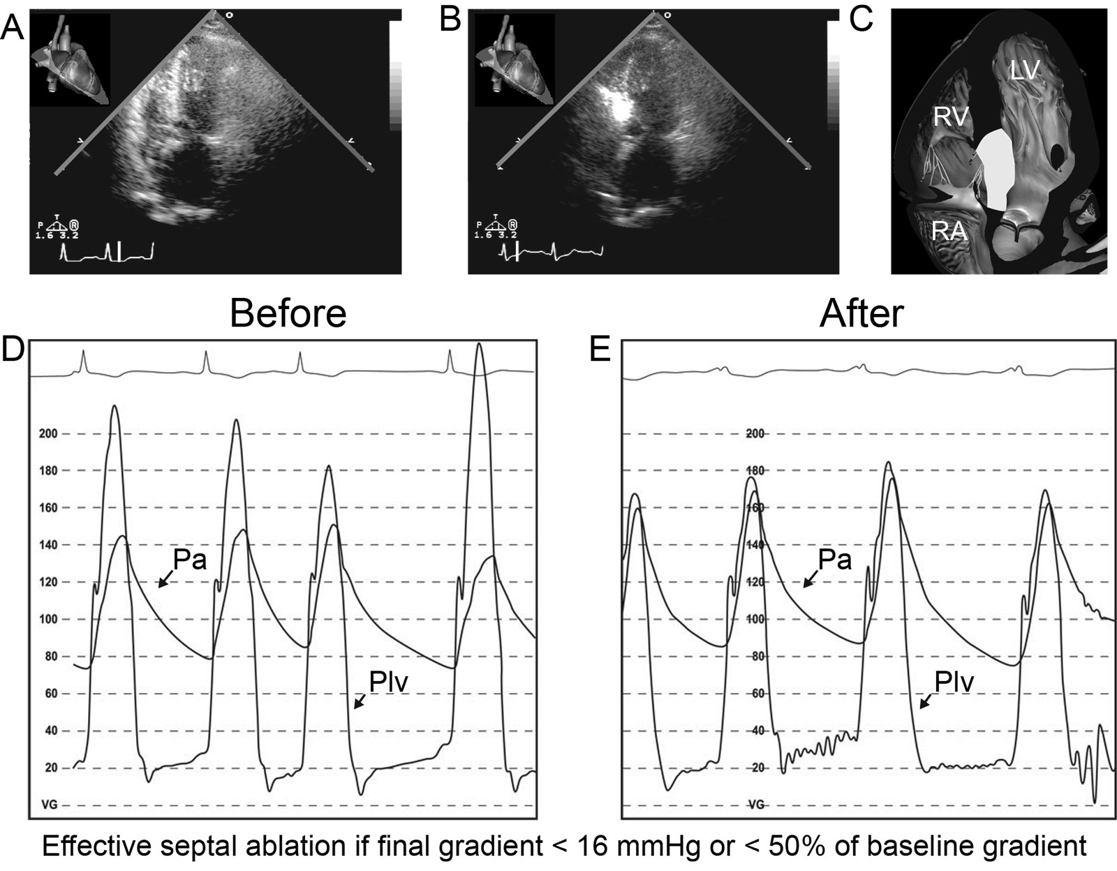 Percutaneous alcohol septal ablation. (A-C) These are TTE apical 5C views before and during the procedure. Myocardial contrast enhancement of the brightened septal area confirms that the septal branch to be injected is indeed the one providing the vascular supply to the SAM septal contact region. (D, E) Hemodynamic tracings (D) before and (E) immediately after percutaneous alcohol septal ablation show an improved resting systolic PG.<em> Abbreviations</em>: 5C, five-chamber; LV, left ventricle; Pa, arterial pressure; PG, pressure gradient; Plv, left ventricular pressure; RA, right atrium; RV, right ventricle; SAM, systolic anterior motion; TTE, transthoracic echocardiography