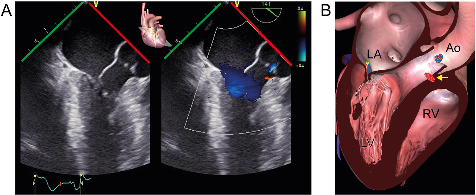 Septal perforator. (A, B) ME LAX color-compare view with CFI during diastole post-myomectomy for HCM shows a septal perforator in the proximal IVS (arrow) at the same time as the trace of AR.<em> Abbreviations</em>: Ao, aorta; AR, aortic regurgitation; CFI, color flow imaging; HCM, hypertrophic cardiomyopathy; IVS, interventricular septum; LA, left atrium; LAX, long-axis; LV, left ventricle; ME, mid-esophageal; RV, right ventricle. <i class='fa fa-video-camera' aria-hidden='true'></i>