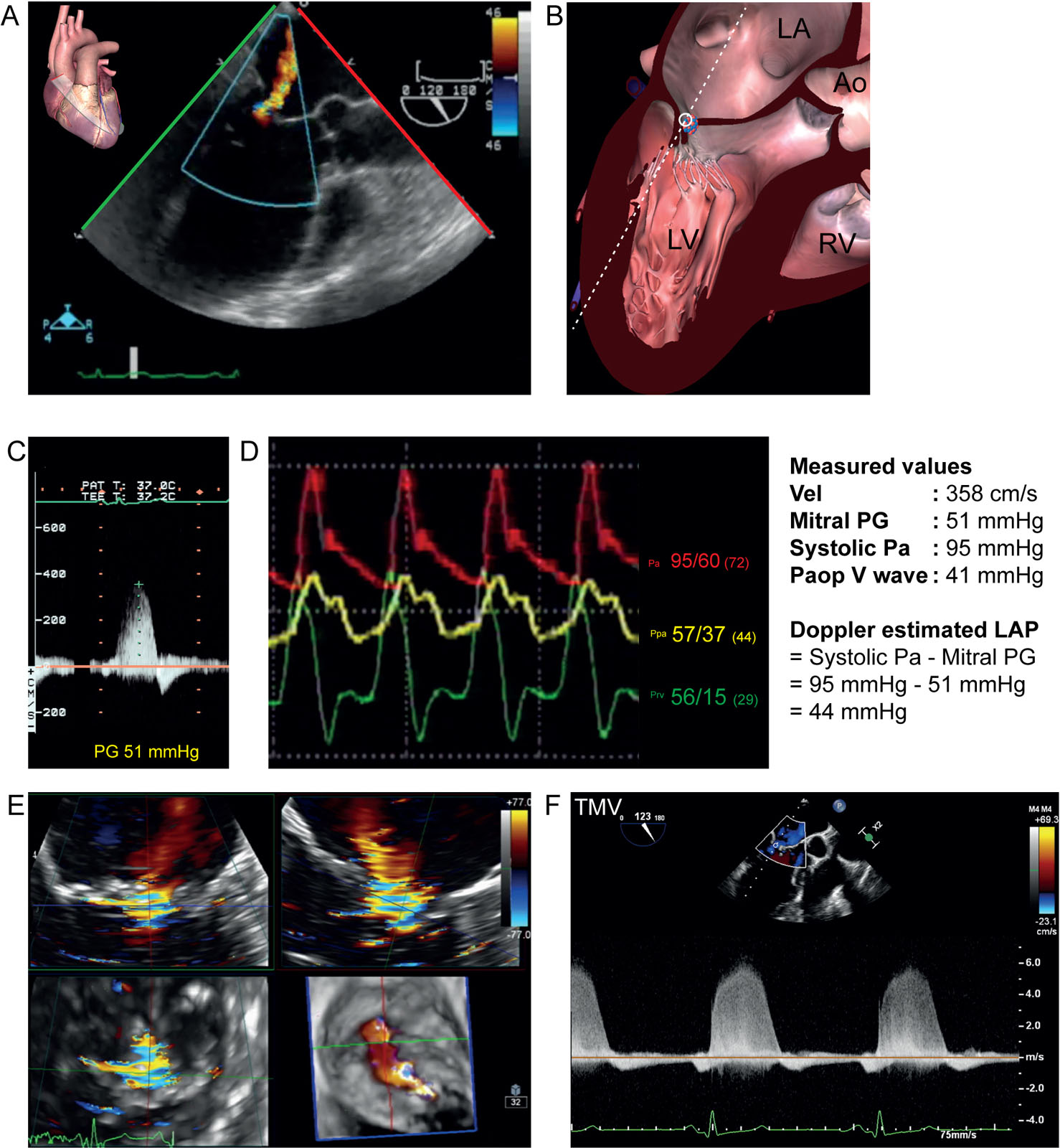 MR in DCM. This is a 56-year-old woman with dilated ischemic cardiomyopathy prior to coronary revascularization, surgical ventricular remodeling and mitral valve repair. (A, B) The ME LAX view with CFI shows MR. (C) ME LAX view with CWD can obtain a spectral Doppler trace of MR, which can estimate the LAP. The maximal PG between the LV and LA was 51 mmHg. With a systolic Pa of 95 mmHg which is equal to the LV systolic pressure, the estimated maximal LAP is (95 mmHg – PG) and equal to 44 mmHg. (D) There was severe pulmonary hypertension with a diastolic Ppa of 37 mmHg and a “V” wave of 41 mmHg. (E, F) MPR of the MV in a 62-year-old man with DCM. Note the eccentric VCA and the dense MR signal on CWD. .<em> Abbreviations</em>: Ao, aorta; CFI, color flow imaging; CWD, continuous wave Doppler; DCM, dilated cardiomyopathy; LA, left atrium; LAP, left atrial pressure; LAX, long-axis; LV, left ventricle; ME, mid-esophageal; MPR, multiplane reconstruction; MR, mitral regurgitation; Pa, arterial pressure; Paop, pulmonary artery occlusion pressure; PG, pressure gradient; Ppa, pulmonary artery; Prv, right ventricular pressure; RV, right ventricle; TMV, transmitral velocity; VCA, vena contracta area; Vel, velocity. <i class='fa fa-video-camera' aria-hidden='true'></i>