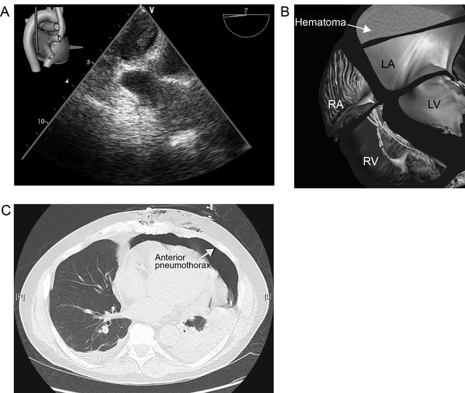 Oblique sinus hematoma. (A, B) ME view at 7° shows a hematoma in the oblique sinus compressing the LA in an unstable patient after cardiac surgery. (C) The CT scan with an anterior pneumothorax (arrow) made a TTE approach impossible for the diagnosis of this condition.<em> Abbreviations</em>: CT, computed tomography; LA, left atrium; LV, left ventricle; ME, mid-esophageal; RA, right atrium; RV, right ventricle; TTE, transthoracic echocardiography. <i class='fa fa-video-camera' aria-hidden='true'></i>