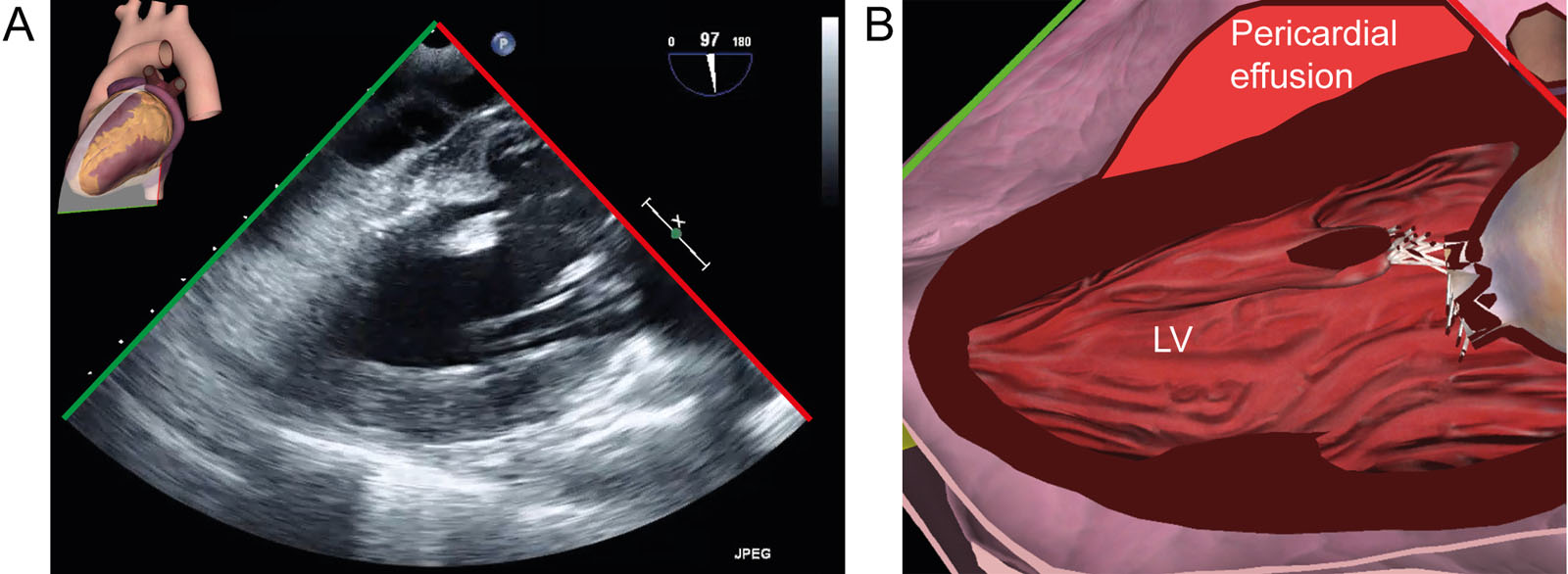 Pericardial effusion. (A, B) TG 2C view shows a posterior pericardial effusion in an unstable 66-year-old man following cardiac arrest.<em> Abbreviations</em>: 2C, two-chamber; LV, left ventricle; TG, transgastric. <i class='fa fa-video-camera' aria-hidden='true'></i>