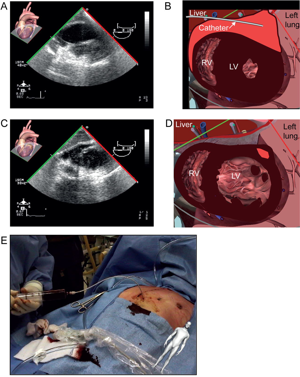 Pericardial drainage. (A-E) These are TG SAX mid-papillary views (A, B) before and (C, D) after percutaneous pericardial drainage of a large (900 ml) pericardial effusion under TEE guidance (E) in the operating room. The guidewire appears behind the ventricles.<em> Abbreviations</em>: LV, left ventricle; RV, right ventricle; SAX, short-axis; TEE, transesophageal echocardiography; TG, transgastric. Source: Photo courtesy of Dr. Raymond Cartier.