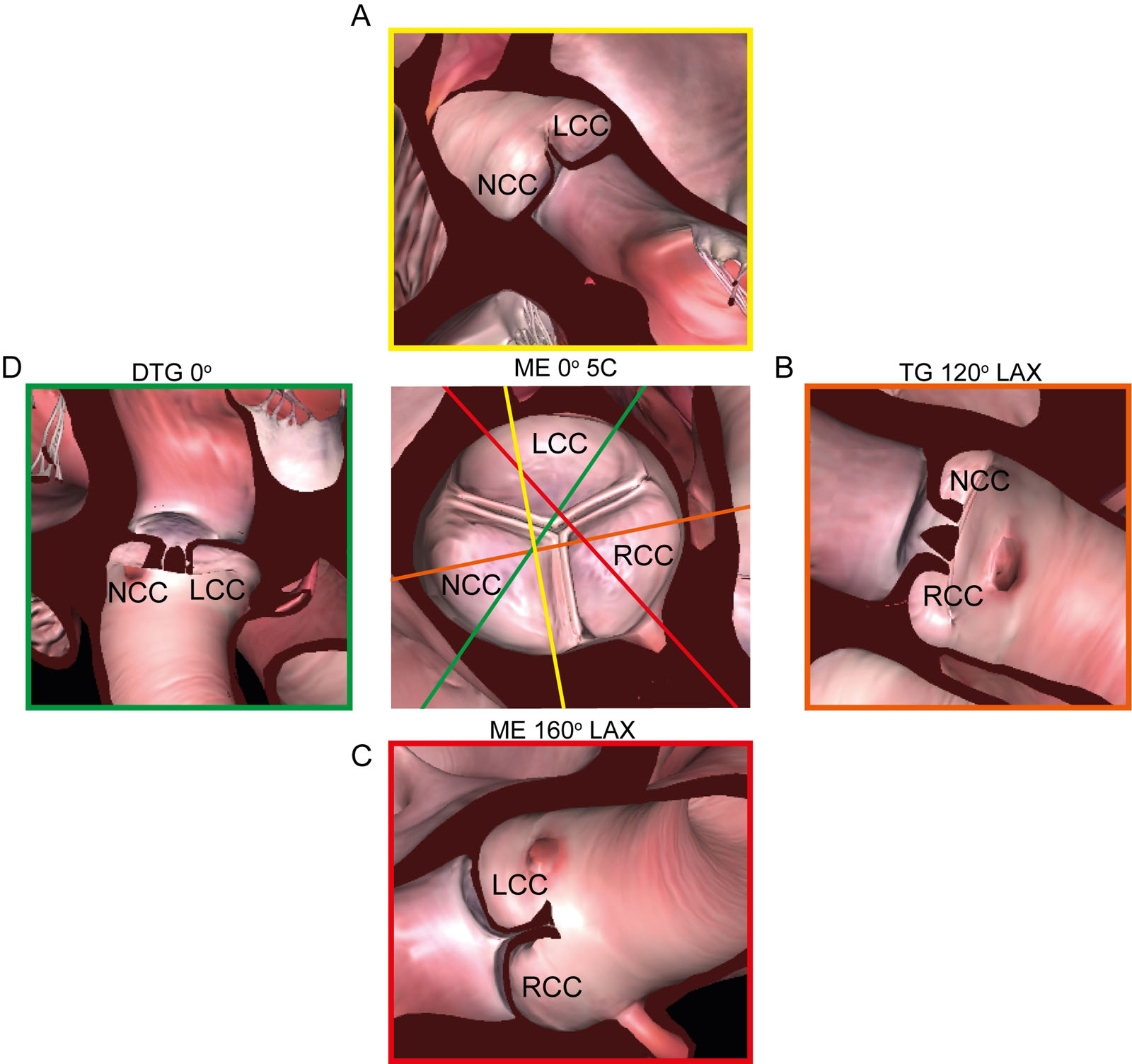 AoV and 2D TEE views. This diagram shows the relationship of ME, TG and DTG TEE views to the AoV cusps.<em> Abbreviations</em>: 2D, two-dimensional; 5C, five-chamber; AoV, aortic valve; DTG, deep transgastric; LAX, long-axis; LCC left coronary cusp; ME, mid-esophageal; NCC, non-coronary cusp; RCC, right coronary cusp; TEE, transesophageal echocardiography; TG, transgastric.