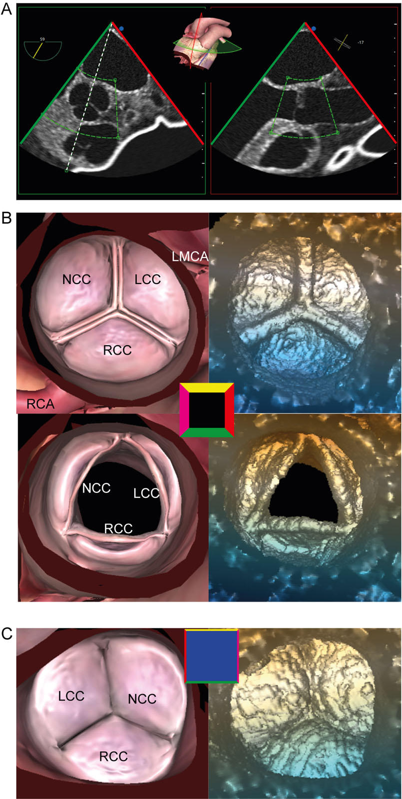 AoV 3D zoom acquisition. (A) 3D zoom acquisition beginning in the ME AoV SAX view should include all three AoV cusps and part of the LVOT and Asc Ao. (B) The 3D AoV dataset appears from the aortic perspective in diastole and systole. (C) A 180° rotation allows visualisation of the AoV from the LV perspective.<em> Abbreviations</em>: 3D, three-dimensional, AoV, aortic valve; Asc Ao, ascending aorta; LCC, left coronary cusp; LMCA, left main coronary artery; LV, left ventricular outflow tract; ME, mid-esophageal; NCC, non-coronary cusp; RCA, right coronary artery; RCC, right coronary cusp; SAX, short-axis. <i class='fa fa-video-camera' aria-hidden='true'></i>