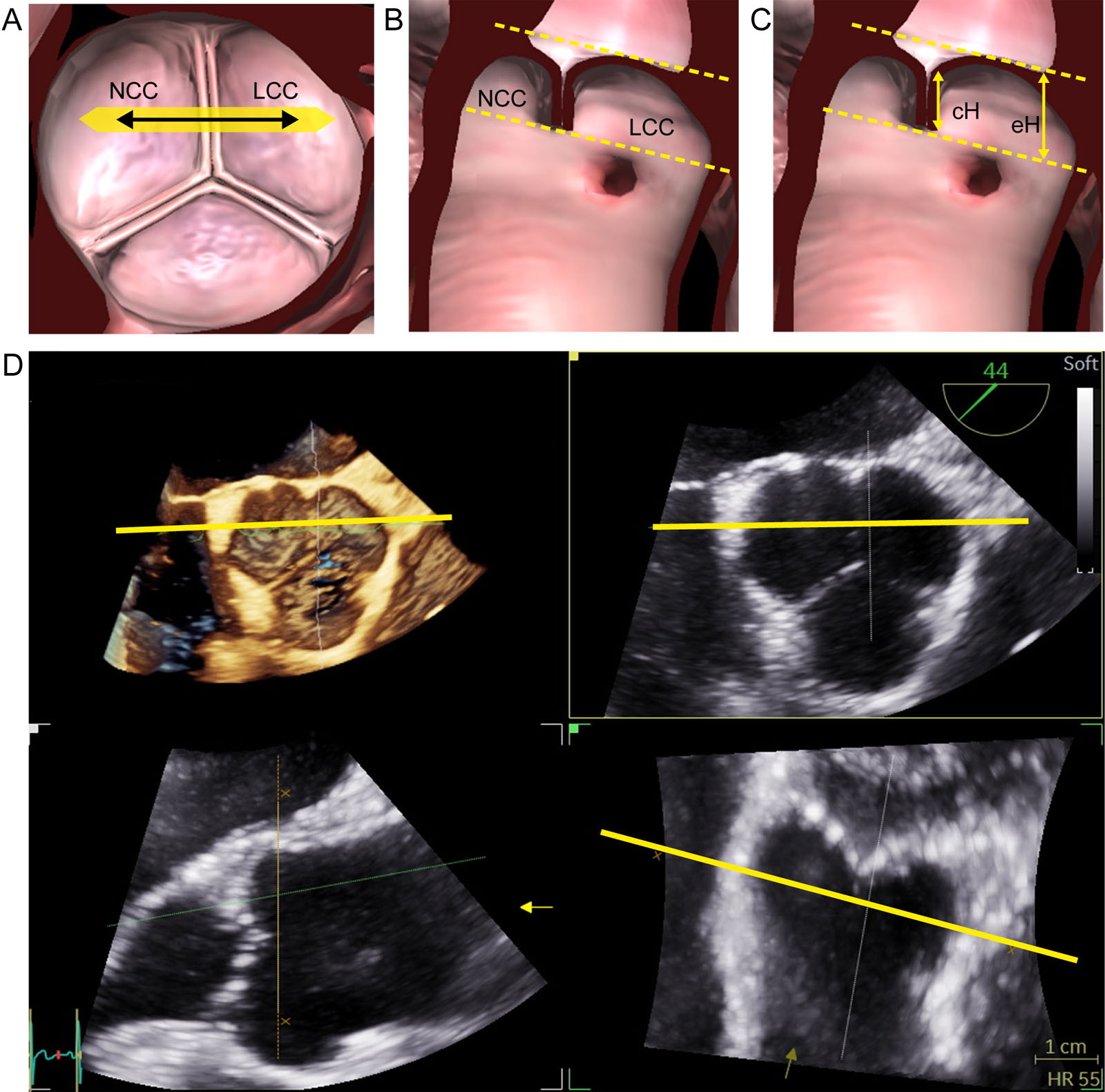 AoV eH and cH measurements of NCC and LCC. (A-C) Measurements are taken between the respective cusps of a normal tricuspid AoV at the inner third of each commissure in the correct adjusted sectional plane. The orthogonal sectional planes through the center of the AoV must be adjusted perpendicular to the commissures between 2 respective cusps. The cH and eH positions between the NCC and the LCC are shown. (D) Corresponding 3D ME SAX view of the AoV with MPR.<em> Abbreviations</em>: 3D, three-dimensional; AoV, aortic valve; cH, coaptation height; eH, effective height; LCC, left coronary cusp; ME, mid-esophageal; MPR, multiplane reconstruction; NCC, non-coronary cusp; SAX, short-axis. Adapted from Hagendorff et al. <sup>2</sup>