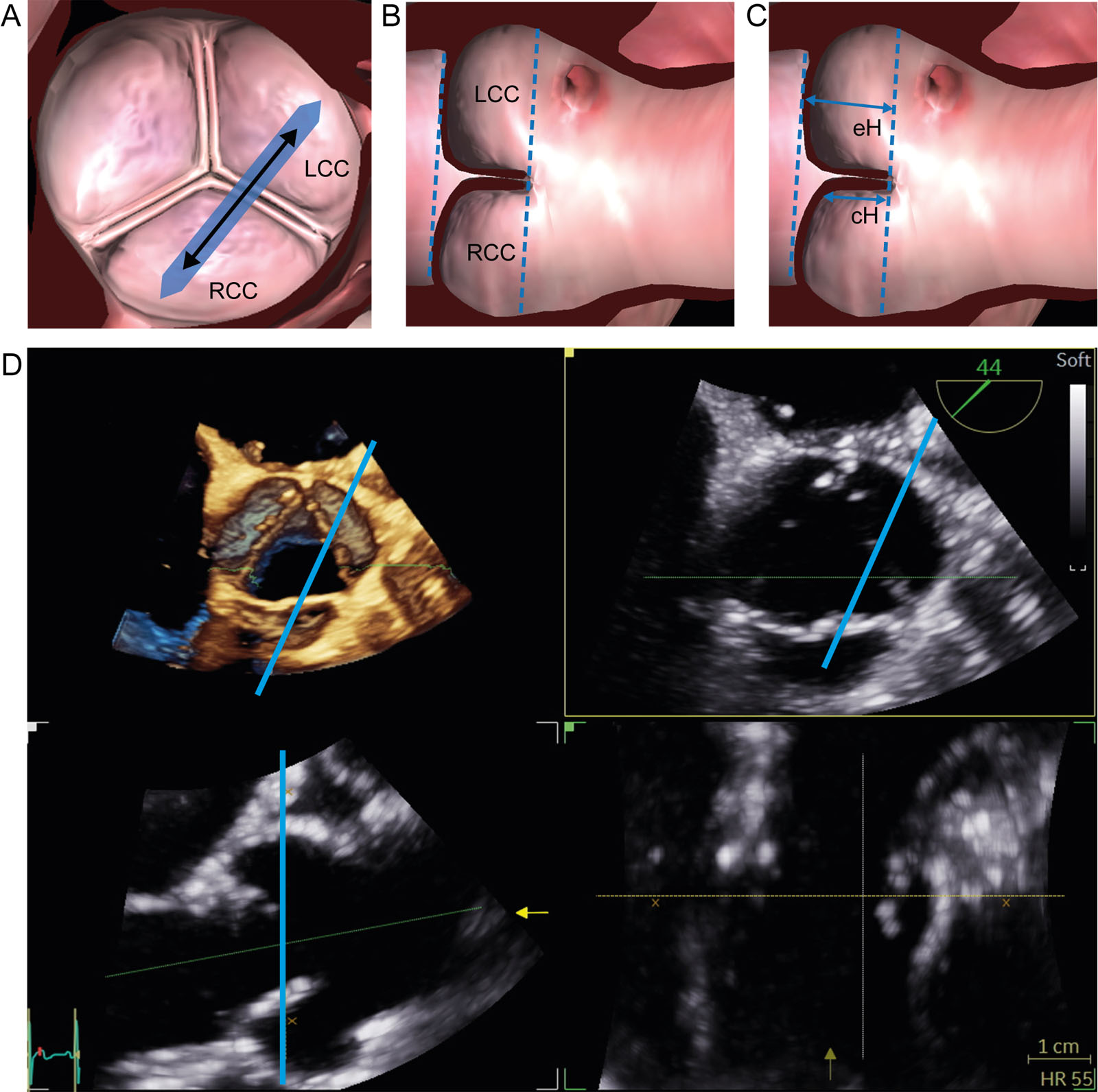 Aortic valve eH and cH measurements of NCC and RCC. (A-C) Measurements should be taken between the respective cusps of a normal tricuspid AoV at the inner third of each commissure in the correct adjusted sectional plane. The orthogonal sectional planes through the AoV center must be adjusted perpendicular to the commissures between 2 respective cusps. The cH and eH positions between the RCC and the LCC appear. (D) Corresponding 3D ME SAX view of the AoV with MPR.<em> Abbreviations</em>: 3D, three-dimensional; AoV, aortic valve; cH, coaptation height; eH, effective height; LCC, left coronary cusp; ME, mid-esophageal; MPR, multiplane reconstruction; RCC, right coronary cusp; SAX, short-axis. Adapted from Hagendorf et al. <sup>2</sup>