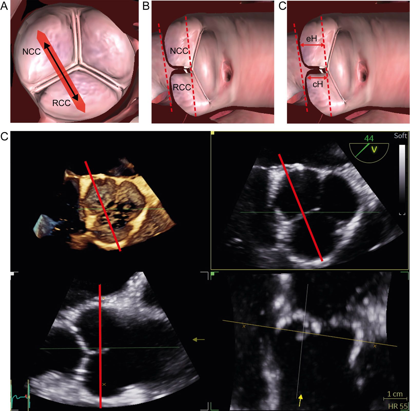 Figure 14.17 AoV eH and cH measurements of <strong>RCC</strong>and NCC. (A-C) Measurements should be taken between the respective cusps of a normal tricuspid AoV at the inner third of each commissure in the correct adjusted sectional plane. The orthogonal sectional planes through the AoV center must be adjusted perpendicular to the commissures between 2 respective cusps. The cH and eH positions between the NCC and the <strong>RCC</strong> appear. (D) Corresponding 3D ME SAX view of the AoV with MPR.<em> Abbreviations</em>: 3D, three-dimensional; AoV, aortic valve; cH, coaptation height; eH, effective height; ME, mid-esophageal; MPR, multiplane reconstruction; NCC, non-coronary cusp; RCC where, right coronary cusp; SAX, short-axis. Adapted from Hagendorff et al.<strong><sup>2</sup></strong> <i class='fa fa-video-camera' aria-hidden='true'></i>