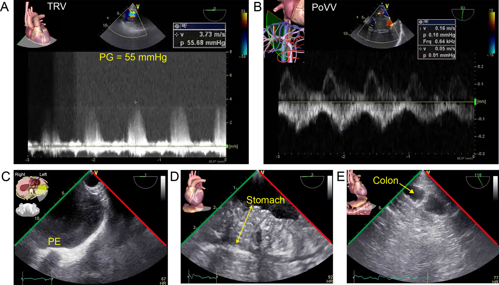 Extra-cardiac AoV stenosis complications. A 79-year-old man with AS presents for THV. (A) CWD interrogation of the TV from the ME RV 4C view shows a TRV peak PG of 55 mmHg. (B) This was associated with portal pulsatility in the PoVV signal. (C-E) TELUS shows a (C) left pleural effusion (PE), and TGAUS shows (D) significant stomach (double arrow) and (E) bowel edema with edema of the semi-lunar fold (arrow). These elements can lead to a cardio-intestinal syndrome.<sup>52</sup><em> Abbreviations</em>: 4C, four- chamber; AoV, aortic valve; CWD, continuous wave Doppler; ME, mid-esophageal; P, pressure; PG, pressure gradient; PoVV, portal vein velocity; RV, right ventricular; TGAUS, transgastric abdominal ultrasound; TELUS, transesophageal lung ultrasound; THV, transcatheter heart valve; TRV, tricuspid regurgitation velocity; TV, tricuspid valve; V, velocity; VV, venous velocity. <i class='fa fa-video-camera' aria-hidden='true'></i>