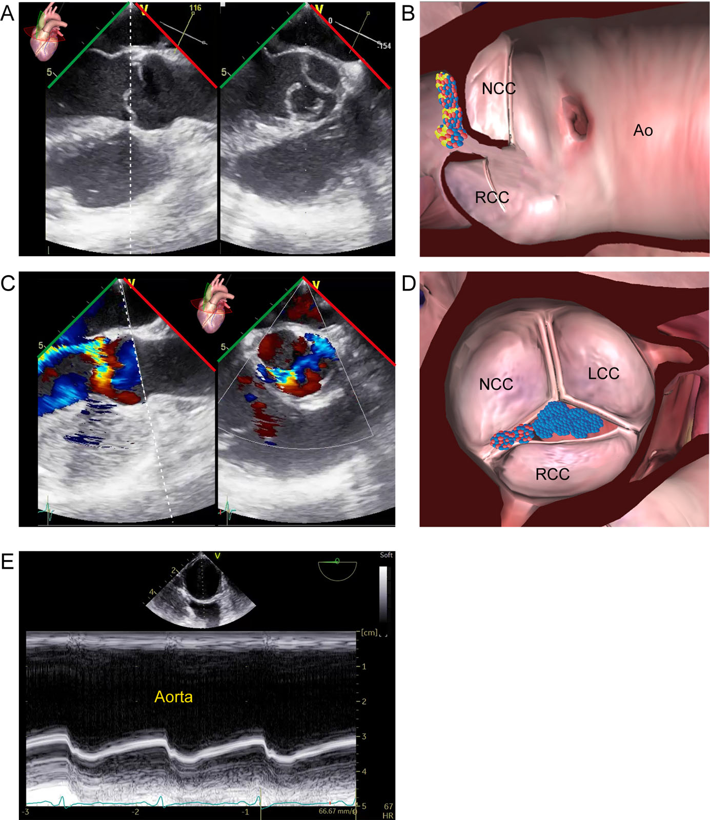 Type II AR. This is an example of AoV RCC prolapse. (A-D) The ME biplane AoV LAX and SAX views with CFI show a RCC partial prolapse with (C, D) a posterior directed AR jet. (E) M-mode of the descending Ao shows increased Ao wall pulsatility (Corrigan pulse).<em> Abbreviations</em>: Ao, aorta; AoV, aortic valve; AR, aortic regurgitation; CFI, color flow imaging; LAX, long-axis; LCC, left coronary cusp; ME, mid-esophageal; NCC, non-coronary cusp; RCC, right coronary cusp; SAX, short-axis.<i class='fa fa-video-camera' aria-hidden='true'></i>