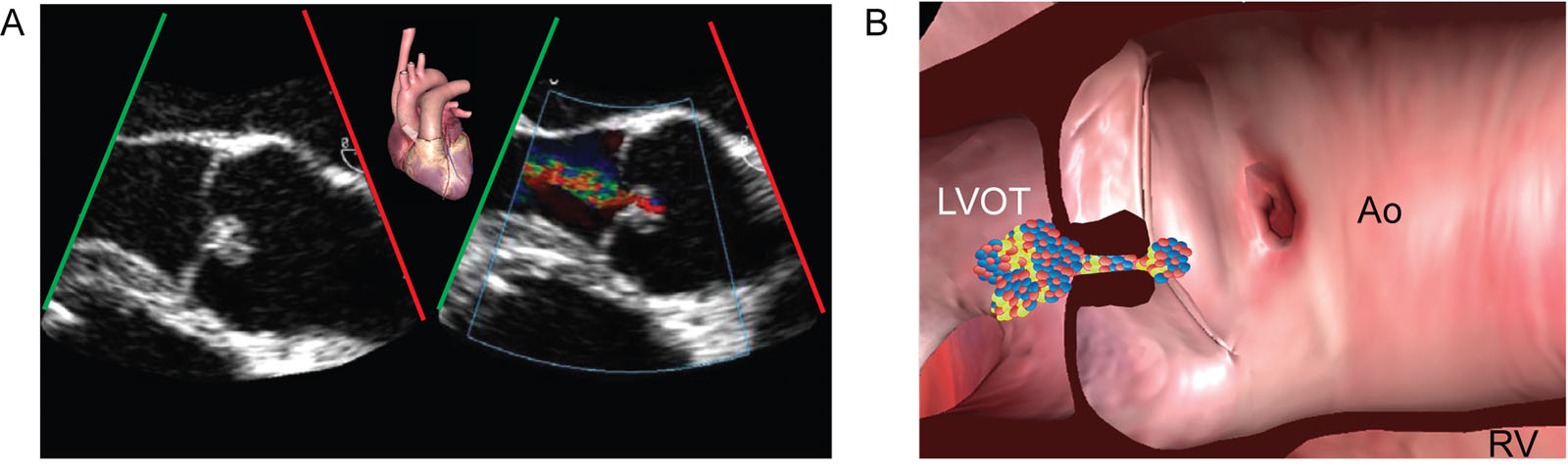 Type III AR. (A, B) The ME AoV LAX view shows thickened cusps that are more echogenic without calcification. There is moderate central AR.<em> Abbreviations</em>: Ao, aorta; AoV, aortic valve; AR, aortic regurgitation; LAX, long-axis; LVOT, left ventricular outflow tract; ME, mid-esophageal; RV, right ventricle. <i class='fa fa-video-camera' aria-hidden='true'></i>