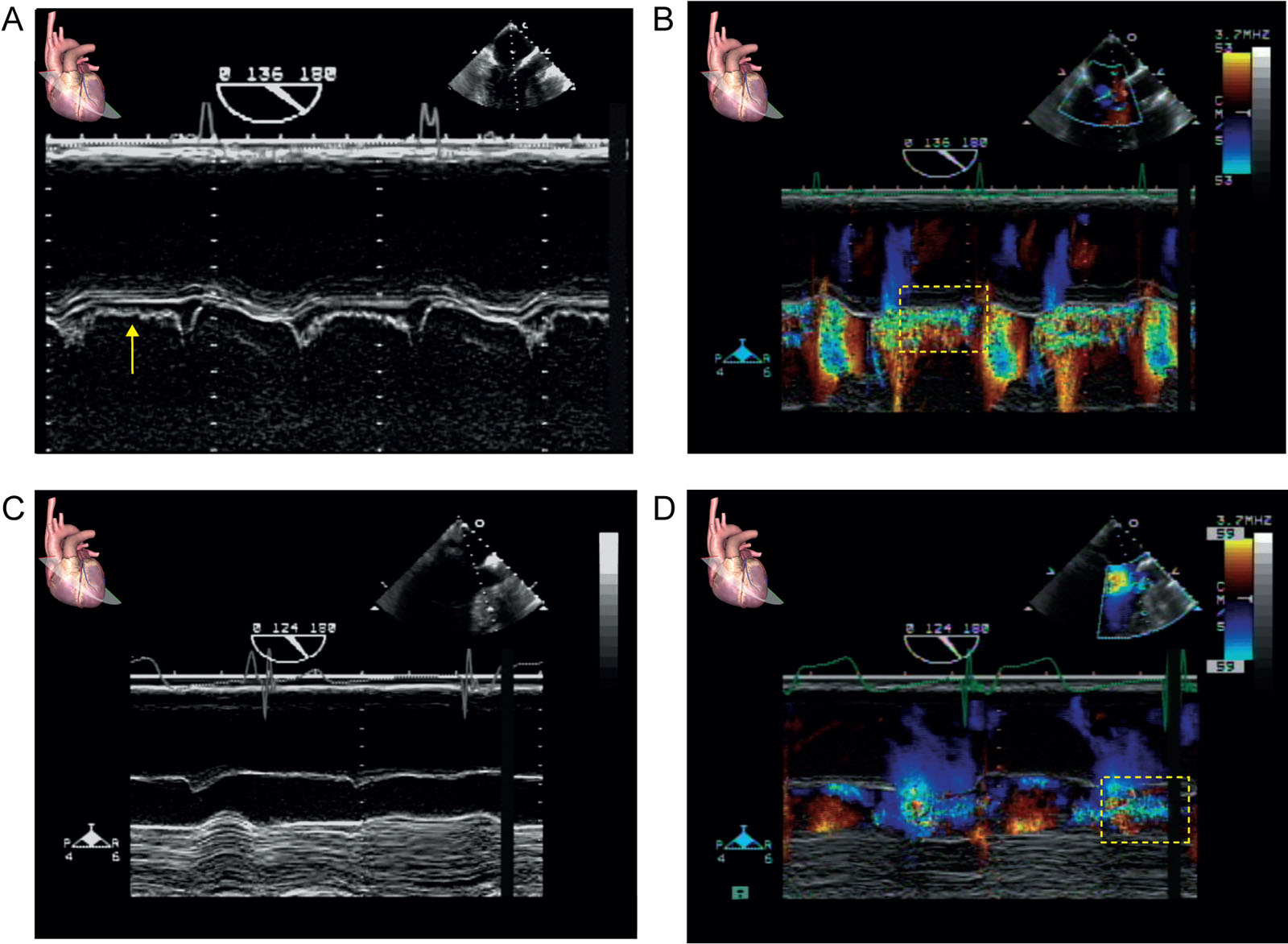 MV fluttering from AR. This is a 56-year-old man with severe AR and AMVL fluttering. M-mode and color M-mode through the AMVL from a ME AoV LAX view (A, B) before and (C, D) after AVR. Note the disappearance of the AMVL fluttering (A, arrow) after intervention. The color M-mode shows significant AR before (box) and (D) trivial AR (box) after AVR.<em> Abbreviations</em>: AMVL, anterior mitral valve leaflet; AoV, aortic valve; AR, aortic regurgitation; AVR, aortic valve replacement; LAX, long-axis; ME, mid-esophageal; MV, mitral valve.