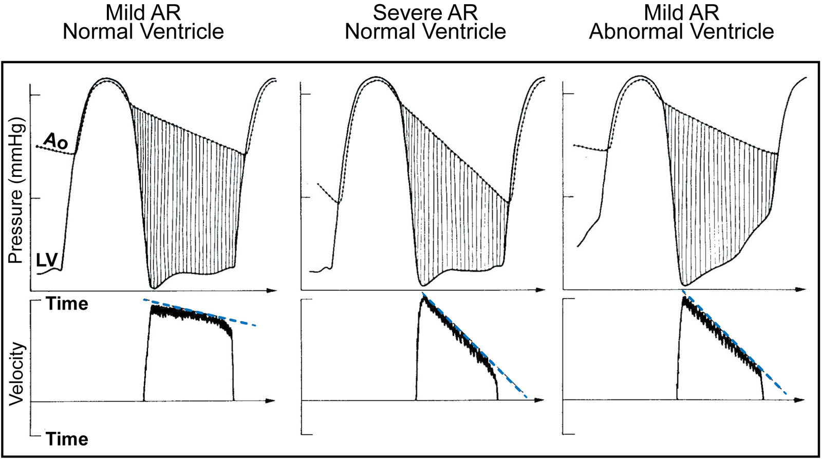 Pressure half-time. This diagram shows the determinants of regurgitant PHT in AR. The upper panels are invasive Ao and LV pressure tracings, the lower panels are CWD tracings across the AoV during diastole. The slope of the blood flow velocity corresponds to the fall in the measured PG between the Ao and LV. Calculation of PHT with Doppler echocardiography derives from the rate of decrease in blood flow velocity across the AoV in patients with AR.<em> Abbreviations</em>: Ao, aorta; AoV, aortic valve; AR, aortic regurgitation; CWD, continuous wave Doppler; LV, left ventricle; PG, pressure gradient; PHT, pressure half-time. Source: Reproduced with permission from Obeid et al.<strong><sup>55</sup></strong>