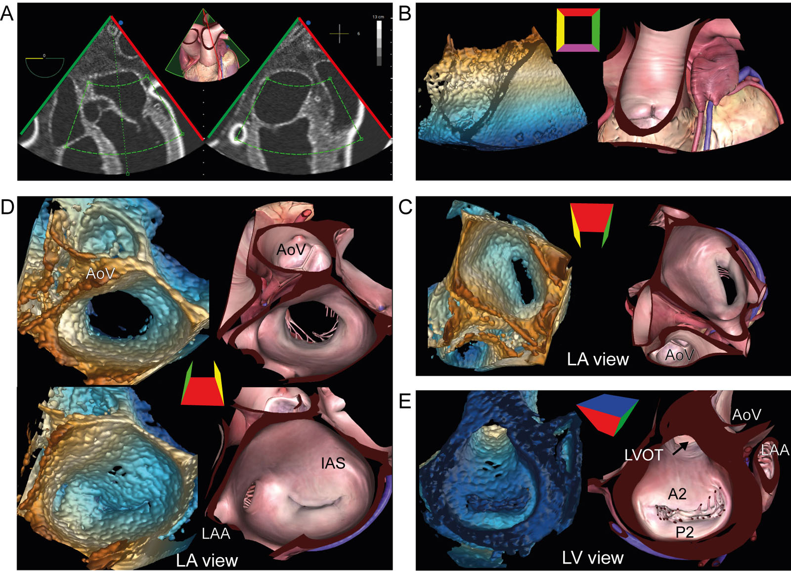 MV 3D zoom acquisition. (A) 3D zoom acquisition should include both MV leaflets, the mitral annulus, and part of the AoV. (B) After acquisition, the 3D frustum is rotated (C) downwards to show the MV from the LA perspective with (D) Z-rotation to position the AoV at the top (12 o’clock) of the display in diastole and in systole. (E) Rotating the 3D frustum 180° from the LA perspective shows the LV perspective.<em> Abbreviations</em>: 3D, three-dimensional, AoV, aortic valve; IAS, interatrial septum; LA, left atrium; LAA, left atrial appendage; LV, left ventricle; LVOT, left ventricular outflow tract; MV, mitral valve. <i class='fa fa-video-camera' aria-hidden='true'></i>