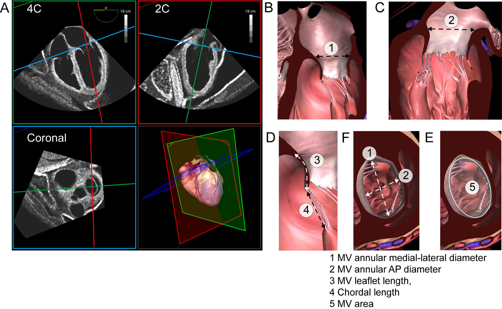 MV MPR measurements. (A) Mid diastolic MV measurements of the mitral annulus dimensions from a simulated 3D TEE dataset showing the ME 4C, orthogonal ME 2C view and coronal view through the TV and MV annuli. (B-F) The derived measurements include: 1) MV annular medial-lateral diameter, 2) MV annular AP diameter, 3) MV leaflet length, 4) chordal length, and 5) MV area.<em> Abbreviations</em>: 2C, two-chamber; 3D, three-dimensional; 4C, four-chamber; AP, antero-posterior; ME, mid-esophageal; MPR, multiplane reconstruction; MV, mitral valve; TEE transesophageal echocardiography; TV, tricuspid valve.