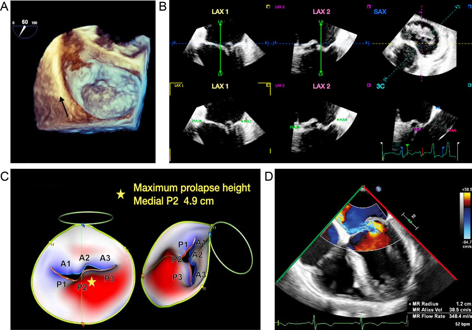 Dynamic 3D parametric MV model. (A) This is a 3D “en-face” view of the MV, in a patient with MV prolapse and flail. (B) This semi-automated software allows the user to align and landmark the 3D MV dataset in MPR views. (C) Subsequent analysis produces a dynamic systolic parametric MV model, showing P2 flail and P3 prolapse from “en-face” and side perspectives. Analysis gives the maximal MV prolapse height, which corresponds to the flail medial P2 segment. Sophisticated 3D measurements as annular diameters, annular non-planarity, commissural lengths, leaflet dimensions, and aortic to mitral annular orientation are possible. (D) ME 4C with CFI demonstrates an eccentric anterior directed MR jet resulting from P2 flail.<em> Abbreviations</em>: 3C, three-chamber; 3D, three-dimensional; 4C. four-chamber; CFI, color flow imaging; LAX, long-axis; ME, mid-esophageal; MPR, multiplane reconstruction; MR, mitral regurgitation; MV, mitral valve; P, posterior; SAX; short-axis. <i class='fa fa-video-camera' aria-hidden='true'></i>